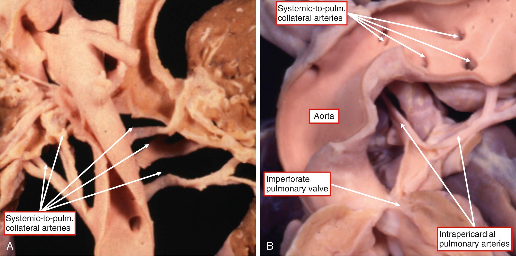 Fig. 36.5, Systemic-to-pulmonary collateral arteries arising from the descending aorta. (A) This heart has been reflected to show the origin of the arteries from the posterior aspect of the descending aorta. (B) This heart is shown from the front, demonstrating the presence of intrapericardial pulmonary arteries. The variation in the anastomoses between the systemic-to-pulmonary collateral arteries and the intrapericardial pulmonary arteries, along with the extent of the intrapericardial arteries, produces the complexity of the pulmonary arterial supply.