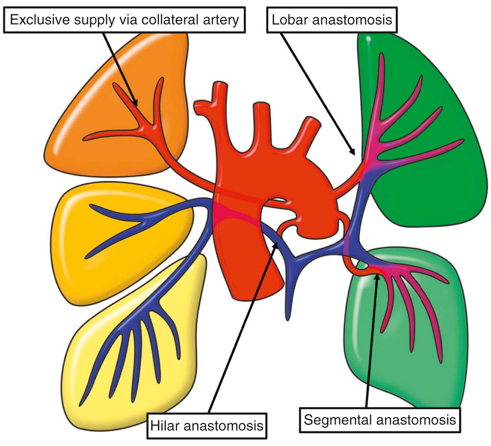 Fig. 36.6, Potential complexity of the pulmonary arterial supply in a hypothetical patient with tetralogy and pulmonary atresia. The three segments of the right upper lobe are shown with exclusive supply through a systemic-to-pulmonary collateral artery. The remainder of the bronchopulmonary segments are fed through intrapericardial pulmonary arteries but with anastomoses with additional systemic-to-pulmonary collateral arteries shown at the hilar, lobar, and segmental levels.