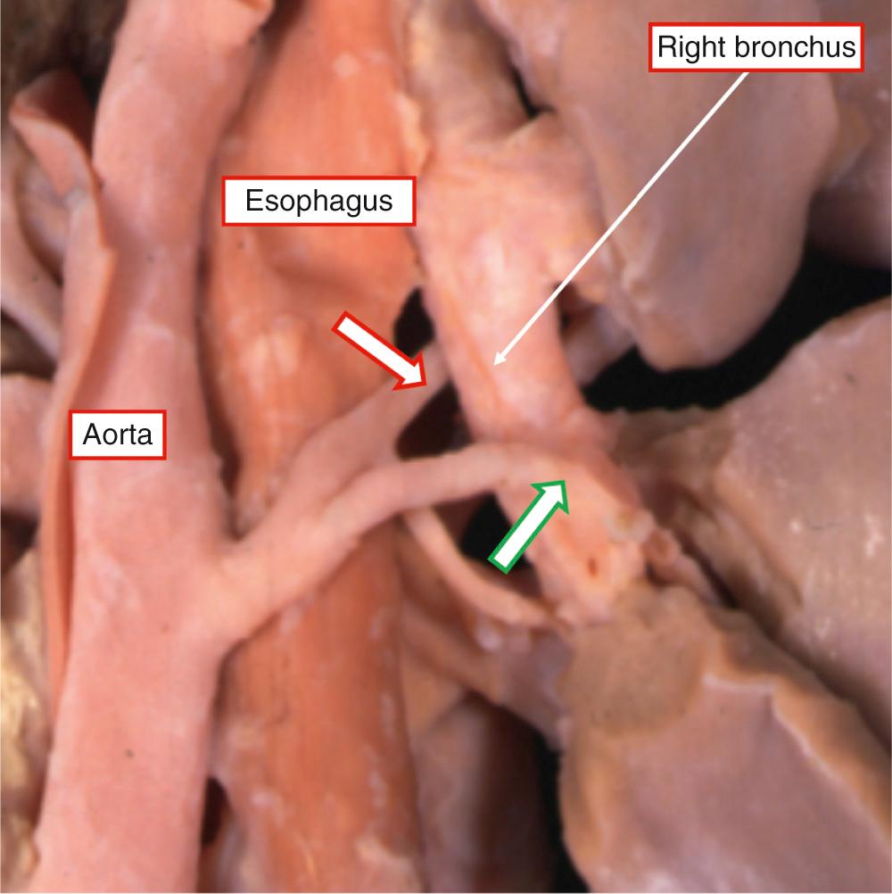 Fig. 36.7, Direct systemic-to-pulmonary collateral artery taking its origin from the descending aorta. The collateral artery passes behind the esophagus but branches to run both in front of (red arrow) and behind (green arrow) the right bronchus. The arteries extend directly into the pulmonary parenchyma.