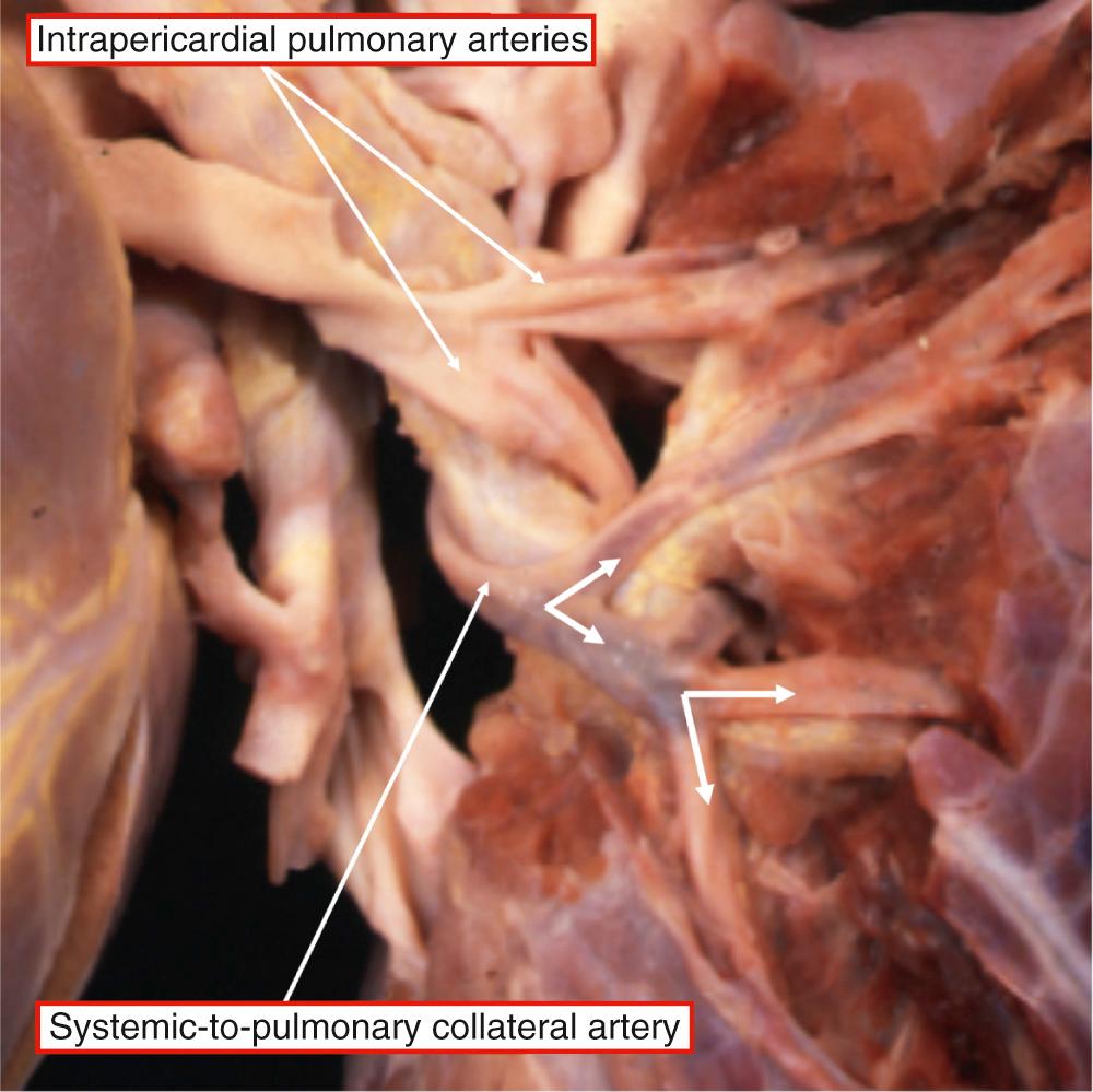 Fig. 36.8, Dissection of a systemic-to-pulmonary collateral artery that branches in concert with the bronchial tree as it extends to supply the pulmonary parenchyma. This vessel could well be a bronchial artery, yet it is accurately described as a systemic-to-pulmonary artery.