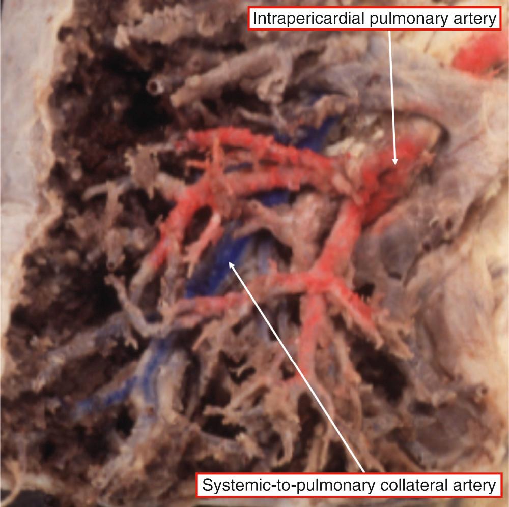 Fig. 36.9, Dissection of the lower lobe of the right lung from a patient with tetralogy and pulmonary atresia. The dissected bronchopulmonary segment has a dual arterial supply with the branches of an intrapericardial pulmonary artery (colored red) and the branches of a systemic-to-pulmonary collateral artery (colored blue) .