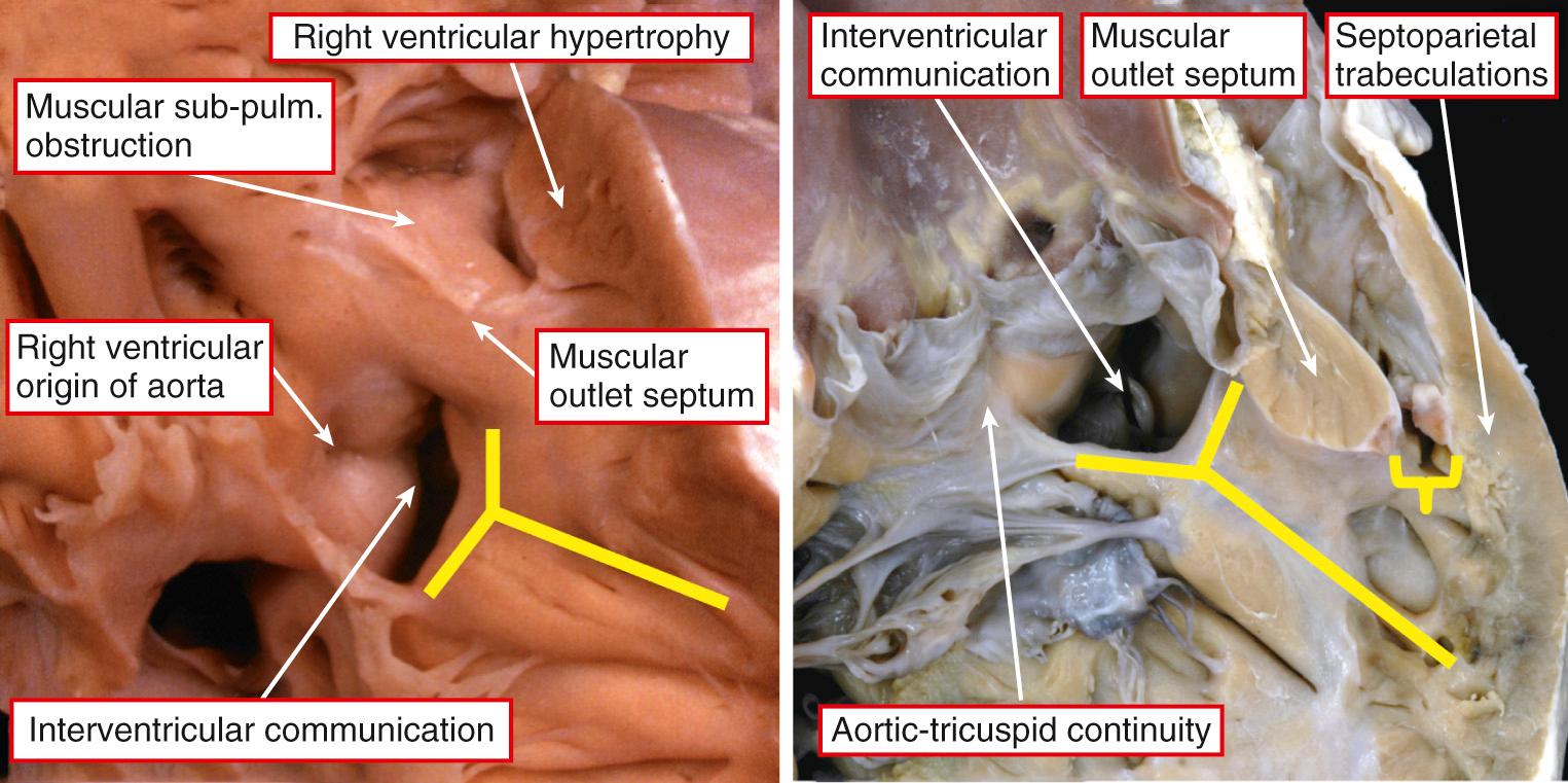 Fig. 35.1, Left, Images taken from the apex of the morphologically right ventricle looking toward the base showing the phenotypic features of tetralogy of Fallot. Right, The major phenotypic feature, insertion of the muscular outlet septum, that separates the overriding component of the artic outlet from the subpulmonary (sub-pulm.) infundibulum to the anterocephalad limb of the septomarginal trabeculation (yellow bars) is shown. As can be seen, this produces a squeeze at the mouth of the infundibulum between the deviated outlet septum and the septoparietal trabeculations (yellow bracket) .