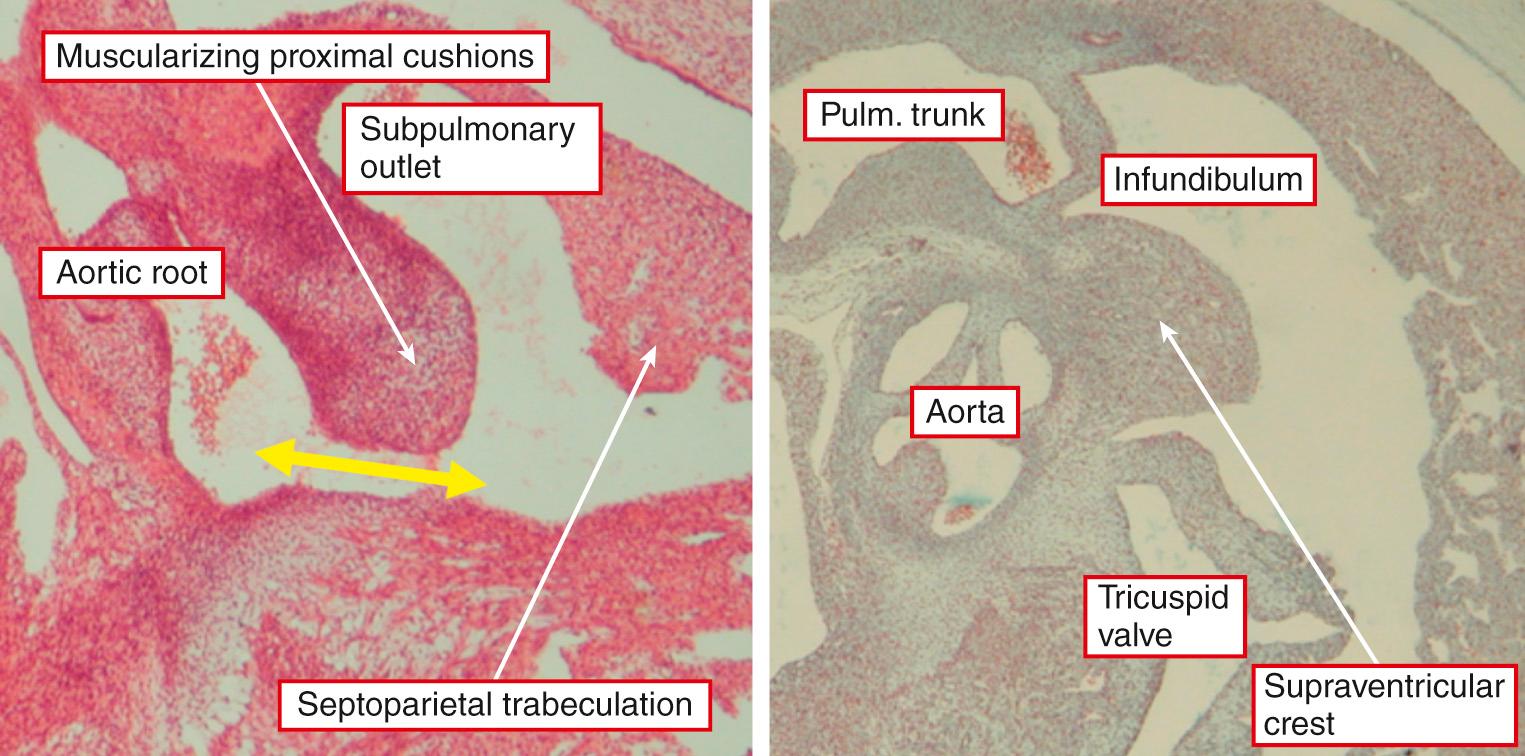 Fig. 35.11, Sections from human embryos showing the change in appearance of the proximal outflow cushions, which muscularize (left) to form the normal supraventricular crest (right) . Both sections are taken to replicate the oblique subcostal echocardiographic projection. The yellow arrow shows the embryonic interventricular communication, which is closed as the aorta is transferred to the left ventricle.