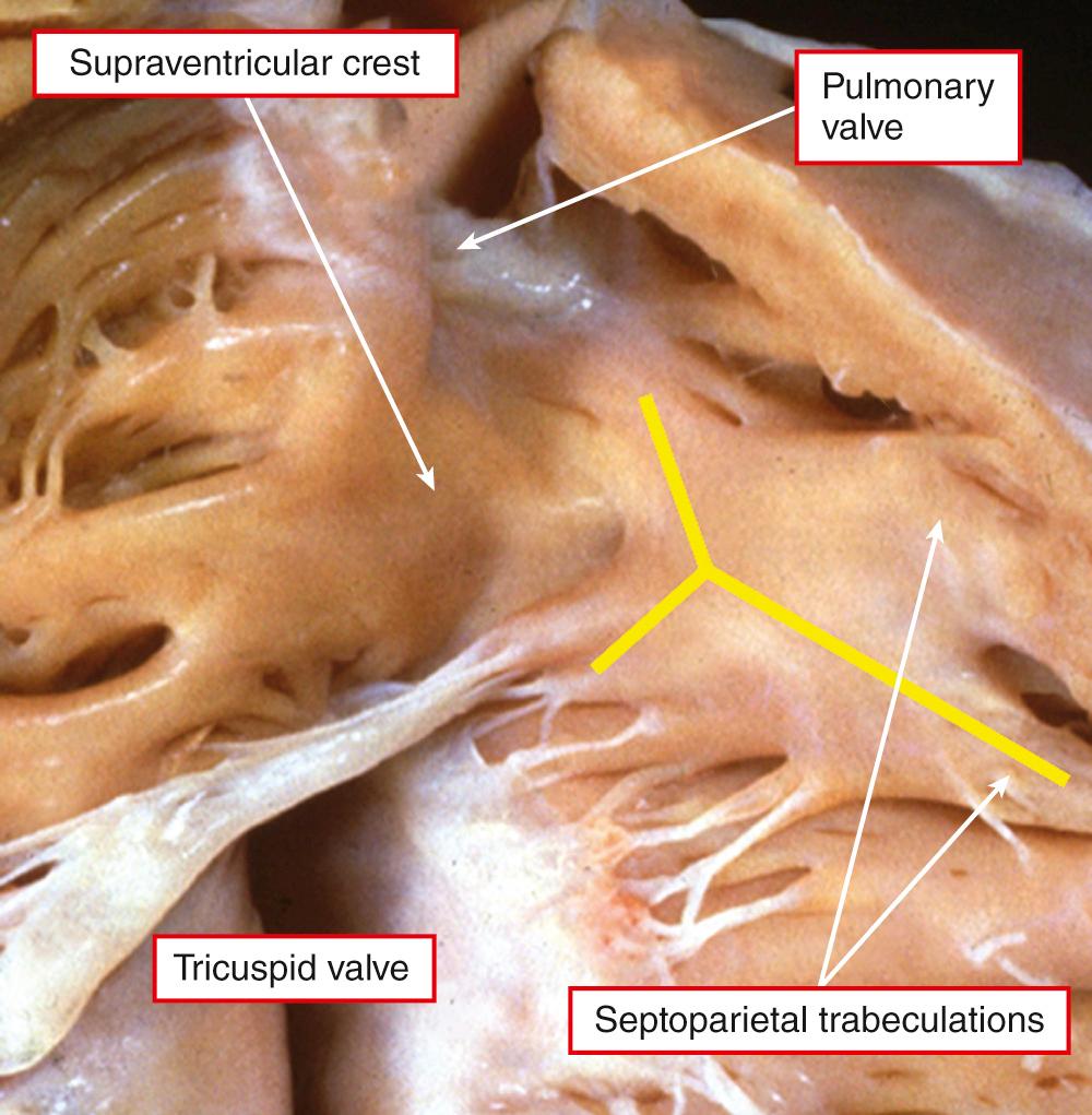 Fig. 35.2, Left, Subpulmonary outflow tract of the normal heart opened to show the supraventricular crest, the muscular fold separating the attachments of the tricuspid and pulmonary valves. It is inserted between the limbs of the septomarginal trabeculation (yellow bars) . Note the location of the septoparietal trabeculations. Right, Dissection of a normal heart revealing that the greater part of the supraventricular crest is the ventriculoinfundibular fold, or inner heart curvature, that supports the freestanding subpulmonary infundibulum. A small part of the area between the limbs of the septomarginal trabeculation can be resected to gain entrance to the left ventricle, but there are no anatomic landmarks delineating this from the inner heart curvature.