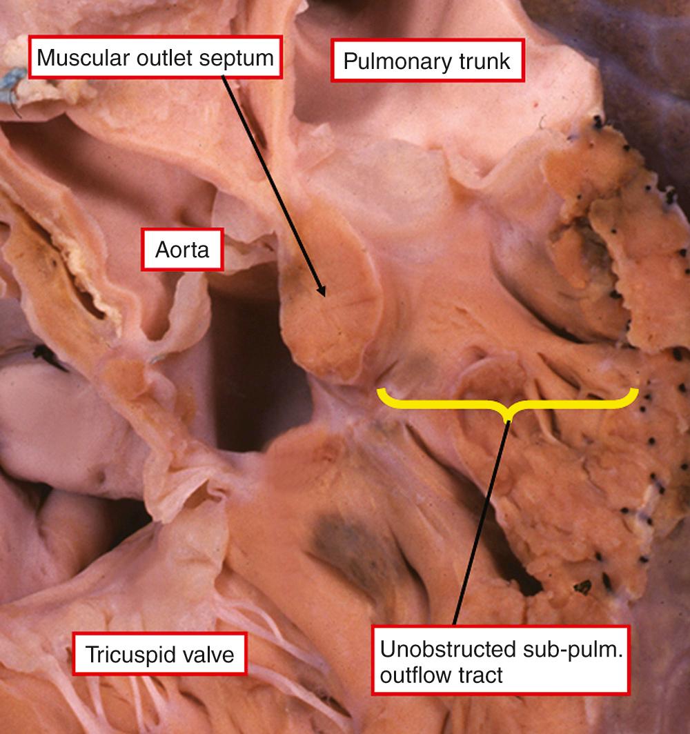 Fig. 35.4, Heart that has been sectioned in the same plane as that shown in the right panel of Fig. 35.1 . There is anterocephalad deviation of the insertion of the muscular outlet septum, but in this instance without producing muscular subpulmomary (sub-pulm.) obstruction. This is the Eisenmenger ventricular septal defect, or the perimembranous outlet defect. It is not an example of tetralogy of Fallot.