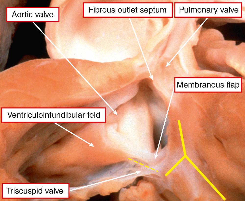 Fig. 35.6, Heart from patient with tetralogy of Fallot in which the ventricular septal defect is roofed by a fibrous outlet septum, which provides continuity between the leaflets of the arterial valves, making it doubly committed and juxta-arterial. The defect also extends to an area of fibrous continuity between the aortic and tricuspid valves, with the ventriculoinfundibular fold stopping short of the posterocaudal limb of the septomarginal trabeculation (yellow bars) . This makes the defect perimembranous and indicates that the conduction axis is at potential risk in its posteroinferior margin (yellow dotted line) . Note the remnant of the interventricular membranous septum, which forms the so-called membranous flap.