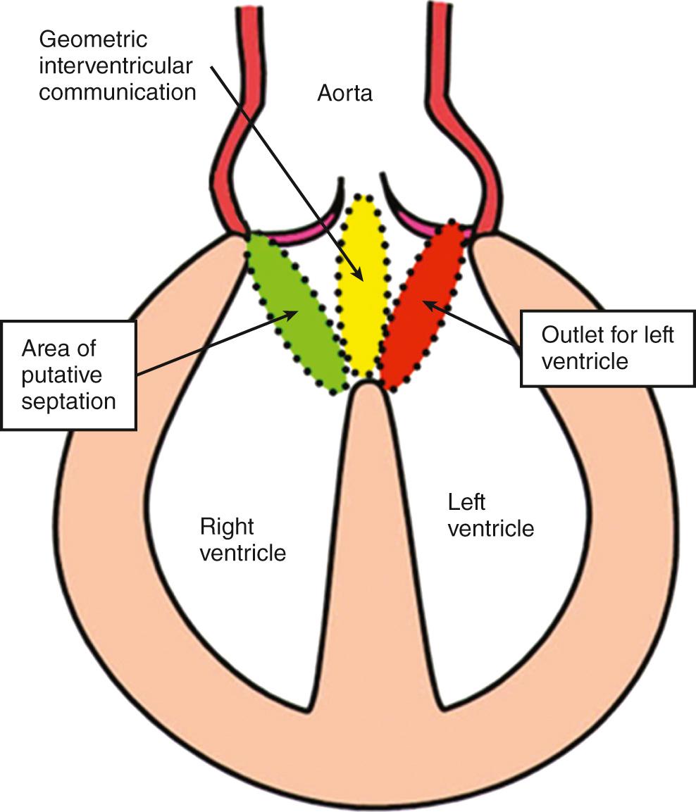 Fig. 35.7, Three areas within the cone of space subtended from the crest of the ventricular septum to the attachments of the overriding aortic valve, which could be defined as the ventricular septal defect. The red disc is the outlet from the left ventricle. The yellow disc is the geometric interventricular communication, representing the cranial continuation of the muscular ventricular septum. The green disk is the ventricular septal defect, since this is the locus along which the surgeon places the patch to reconnect the aorta to the left ventricle.