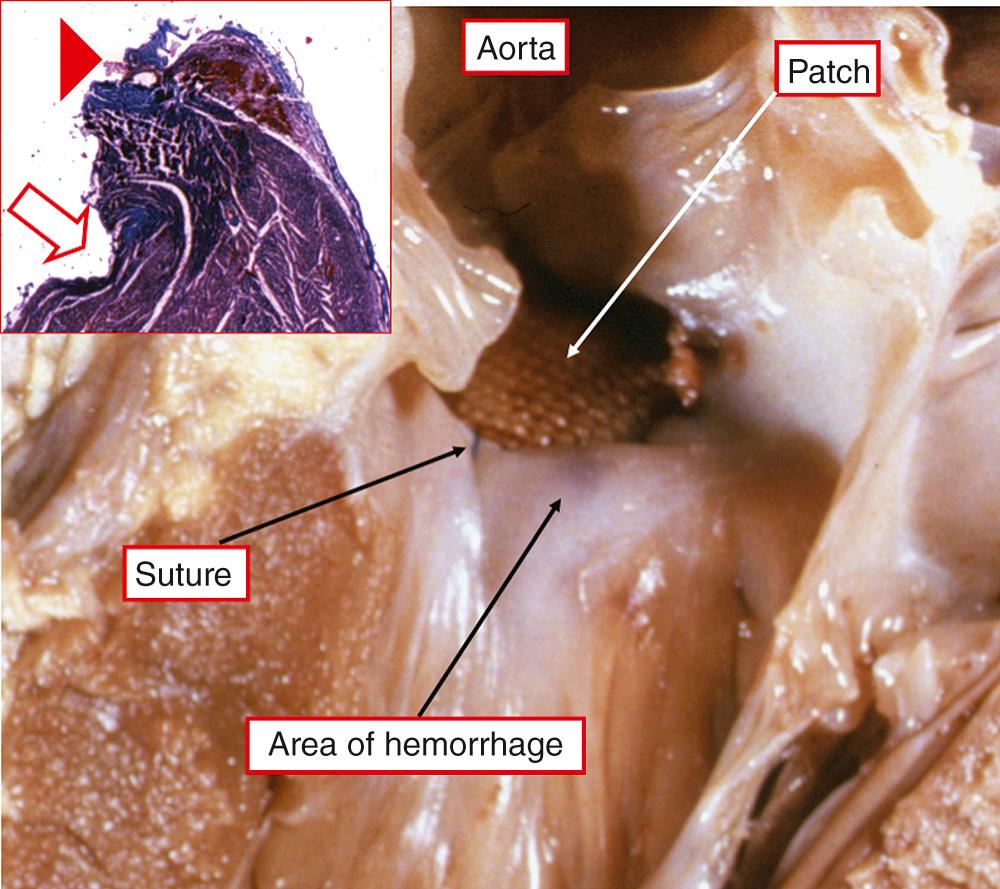 Fig. 35.9, Left ventricular aspect of a heart in which sutures were placed through the crest of the muscular ventricular septum, which was presumed to be a safe area. However, this traumatized the conduction axis, as shown in the inset. The white arrow in the inset shows the “bite” taken by the suture on the right ventricular aspect; the red arrowhead points to the hemorrhage in the conduction axis, as seen in the main image.