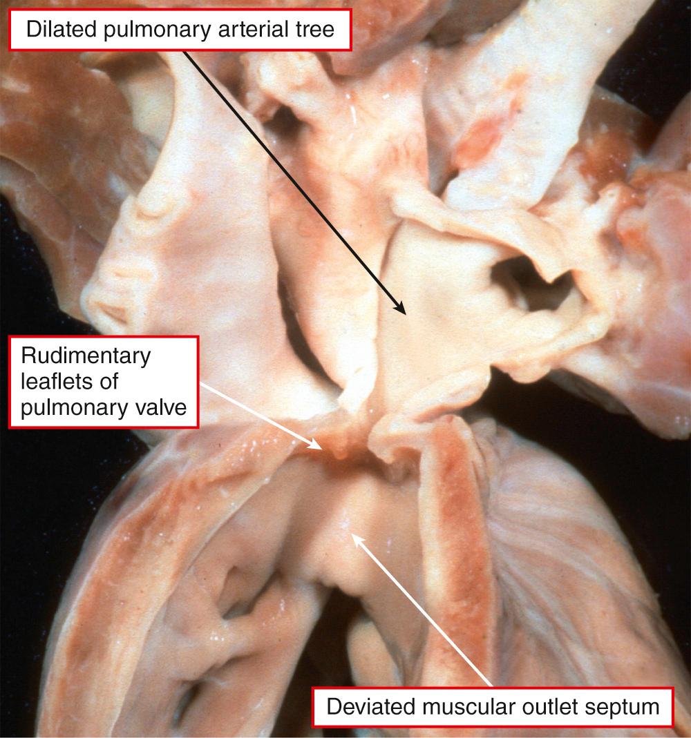 Fig. 35.10, Tetralogy of Fallot with “absence” of the leaflets of the pulmonary valve. In reality, the leaflets form an annular rudimentary array at the ventriculoarterial junction. Note the dilation of the pulmonary trunk and its branches, albeit the ventriculoarterial junction itself is narrowed.