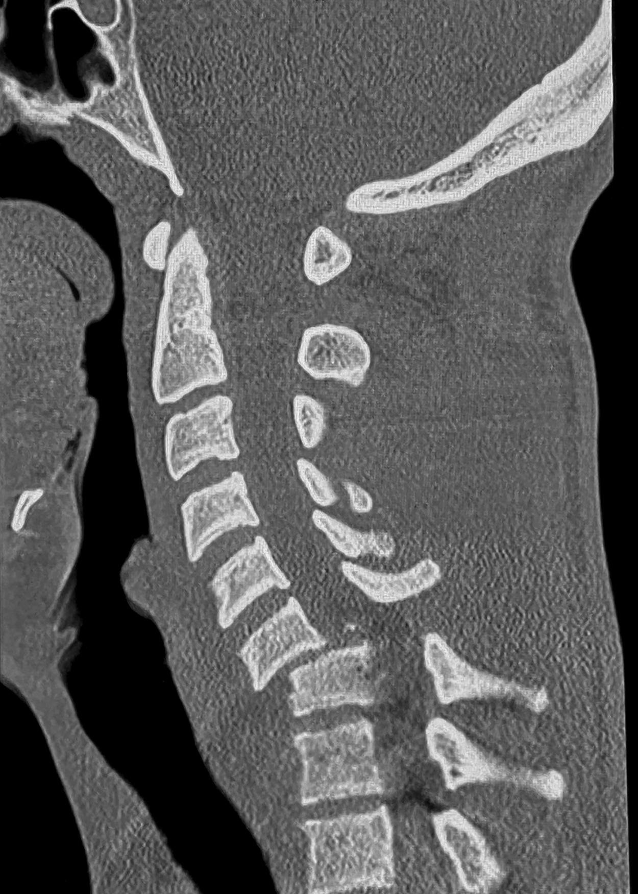 Fig. 33.1, A 17-year-old involved in motor vehicle accident. Lateral computed tomography (CT) scan depicts a C6-C7 dislocation.