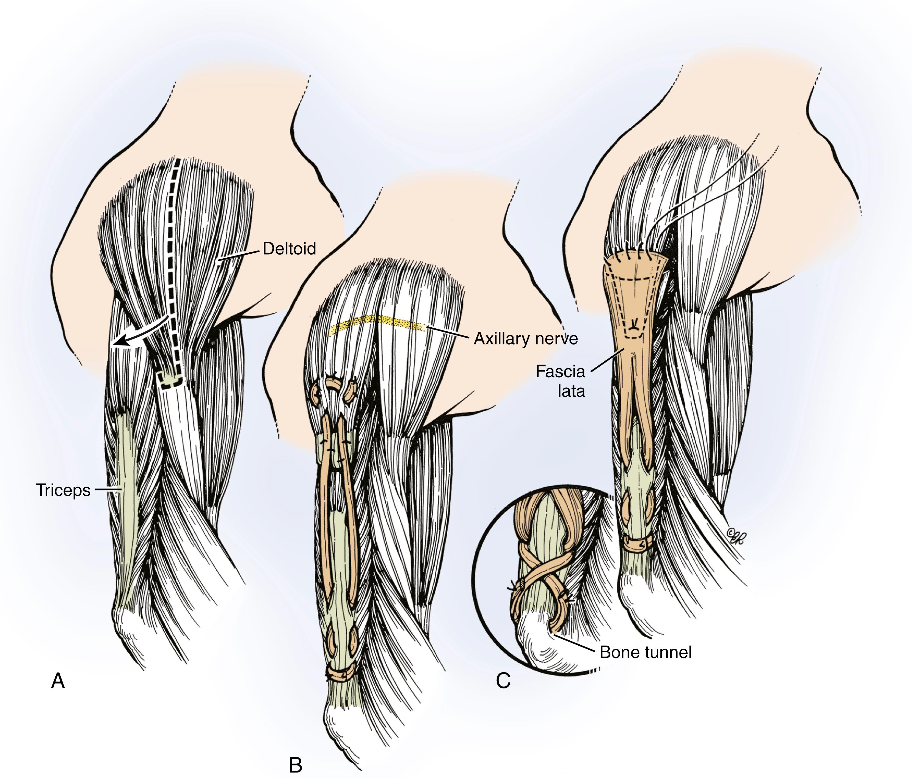 Fig. 33.11, Deltoid to triceps transfer. A, The posterior border of the muscle belly is isolated, preserving as much of the tendinous insertion as possible. B, Tendon grafts are laced into the distal end of the deltoid muscle belly and triceps aponeurosis. C, Fascia lata is used rather than tendon grafts. Direct insertion into the olecranon through a bone tunnel can be performed with either type of graft.