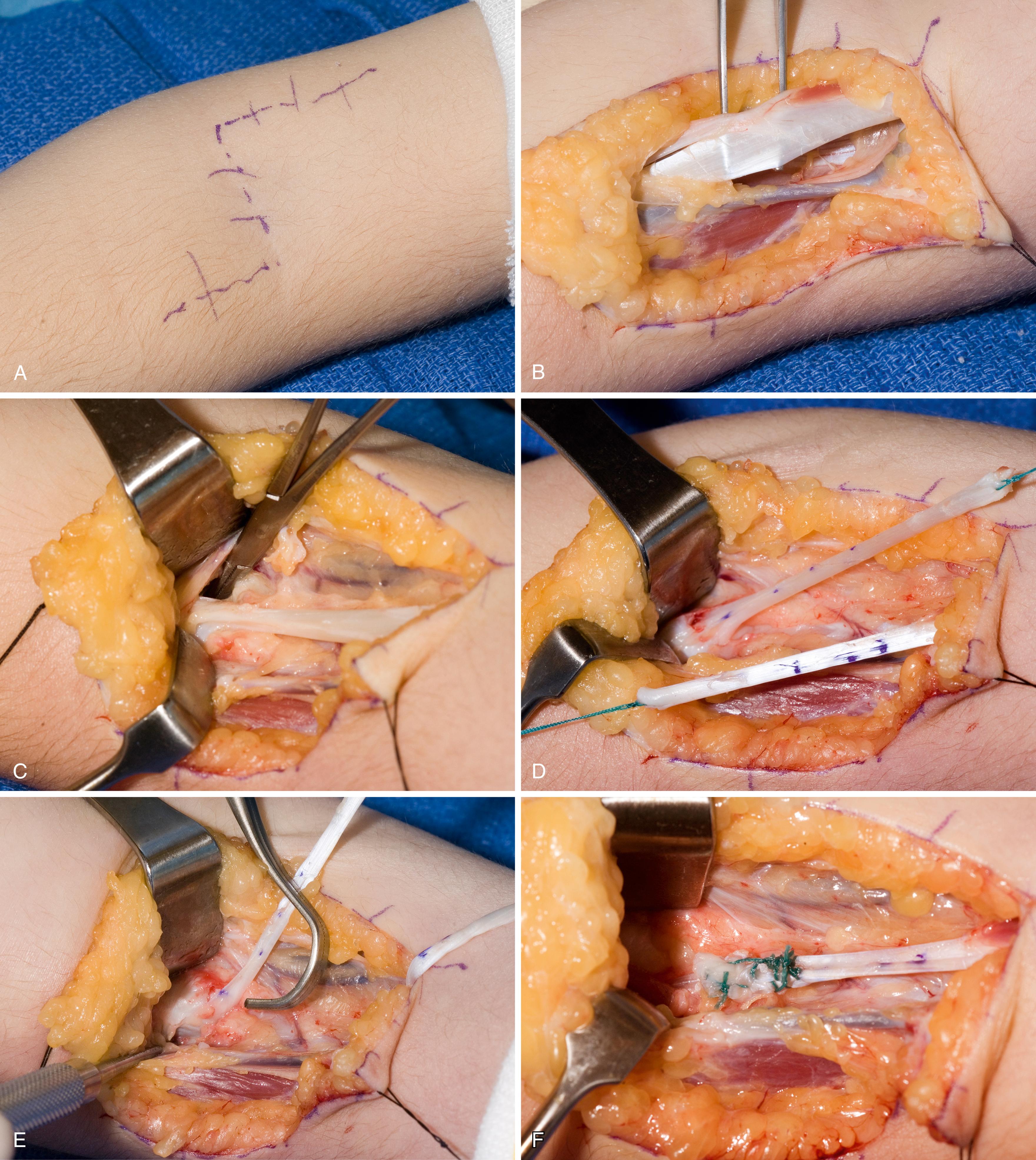 Fig. 33.15, A 6-year-old female with supple supination posturing of her left arm. A, Skin incision for biceps rerouting procedure. B, Isolation of the biceps tendon and lacertus fibrosis. Lateral antebrachial cutaneous nerve just lateral to tendon. C, Biceps tendon traced to its insertion into radial tuberosity. D, Z-plasty of entire biceps tendon with long proximal and distal limbs. E, A curved clamp (Castameda pediatric clamp) facilitates tendon rerouting around the radius. F, Distal limb repaired back to proximal limb using a tendon weave augmented with nonabsorbable suture.