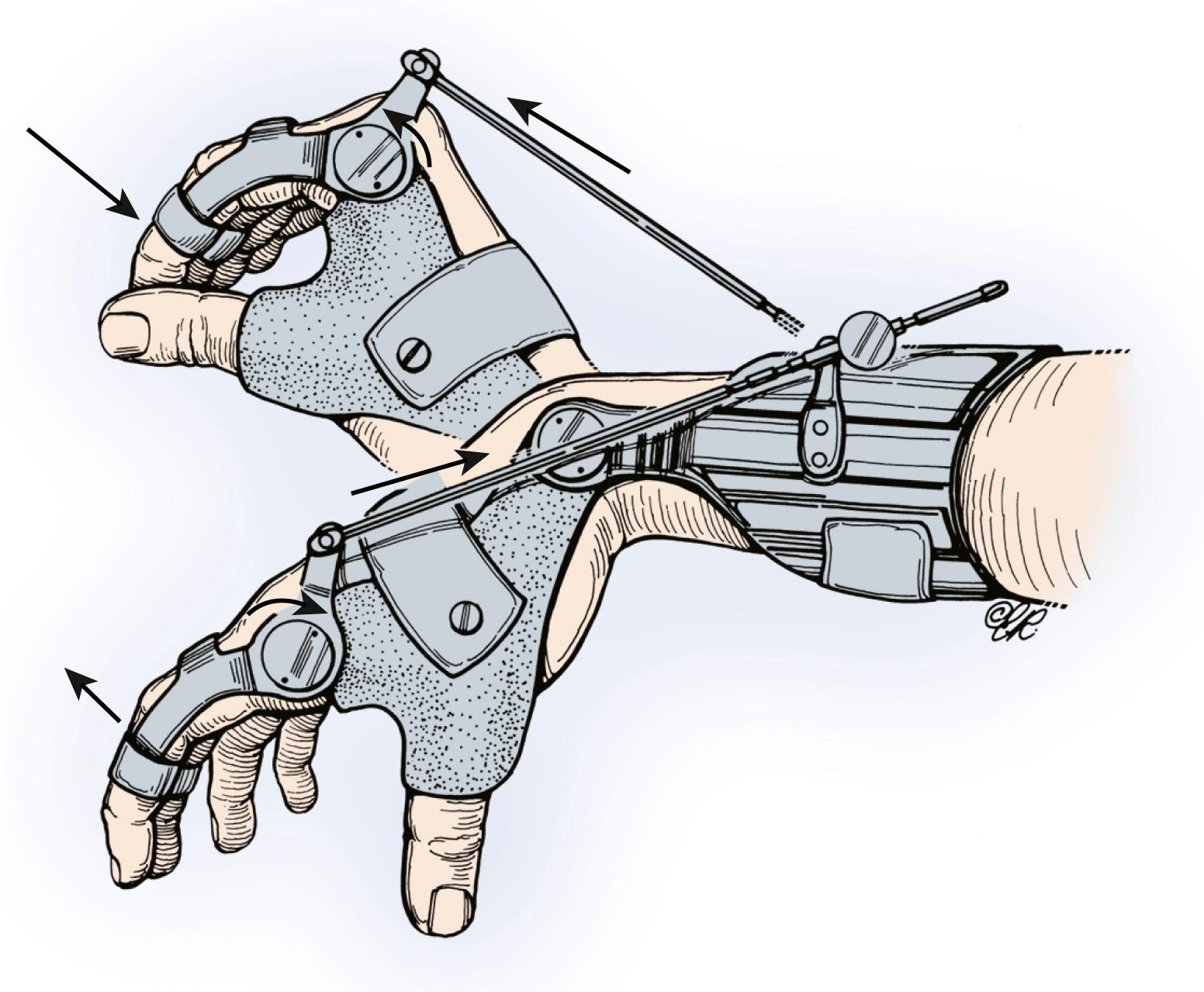 Fig. 33.17, The wrist-driven flexor hinge splint uses the principle of synergistic action. As the wrist is extended, the fingers are flexed to bring them into contact with the thumb, which is fixed. As the wrist is flexed, the fingers are extended.