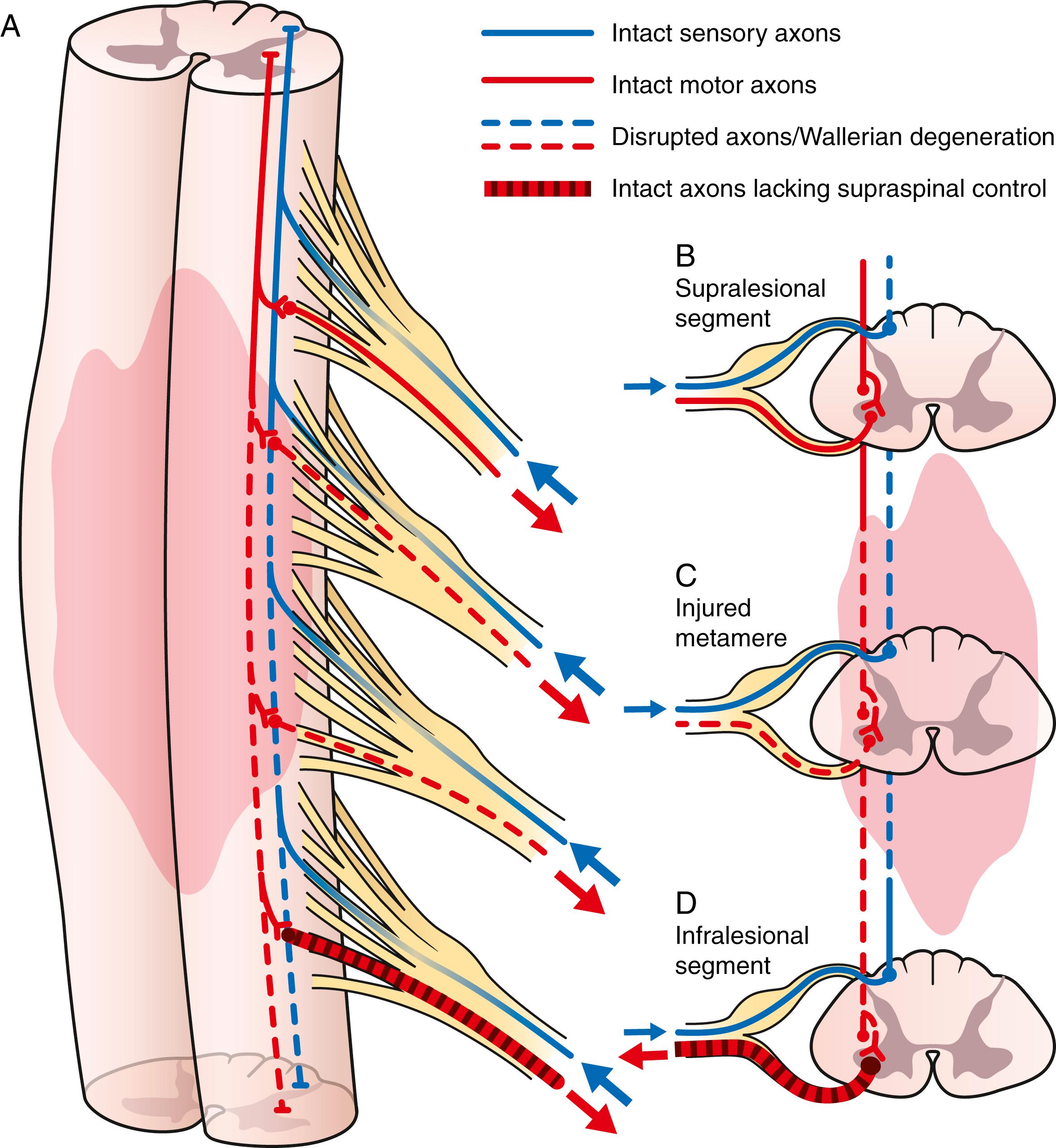 Fig. 33.2, A, Traumatic spinal cord injury produces three different patterns of disruption. B, Spinal lesions above the level of the injury maintain intact control of the peripheral nervous system (C) at the site of actual injury, which experiences both direct tissue disruption and alteration of in- and outgoing connections, and (D) the levels below the site of injury that maintain normal anatomic configuration but no longer receive descending electrical inputs.