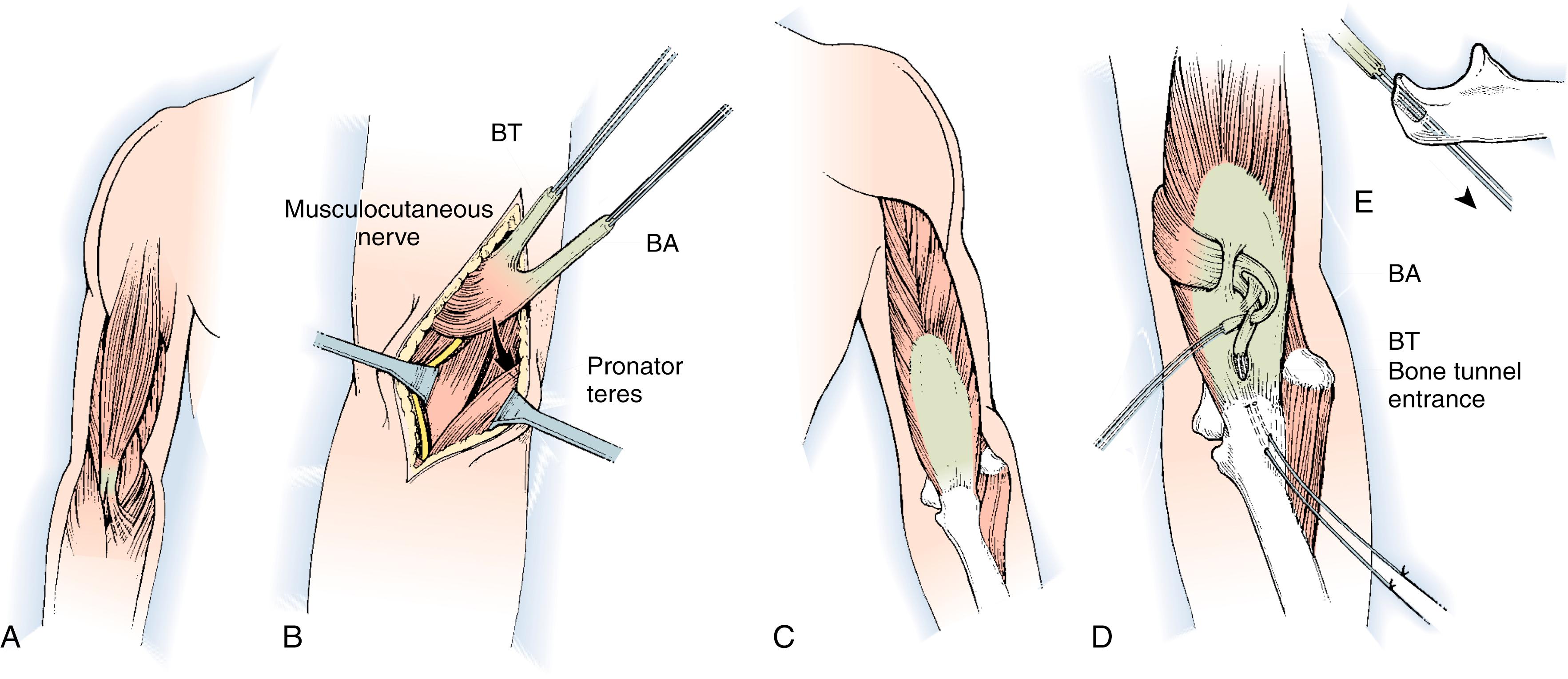 Fig. 33.8, Biceps to triceps transfer. A and B, The biceps tendon (BT) and bicipital aponeurosis (BA; lacertus fibrosus) are released, and the muscle belly is mobilized proximally through an anterior incision. C and D, The biceps is rerouted medially around the arm in the subcutaneous plane and inserted by braiding the tendon “tails” into the triceps tendon. E, Direct insertion of the biceps tendon into a bone tunnel in the olecranon, with heavy sutures tied over bone. This provides strong fixation, permitting relatively early mobilization.