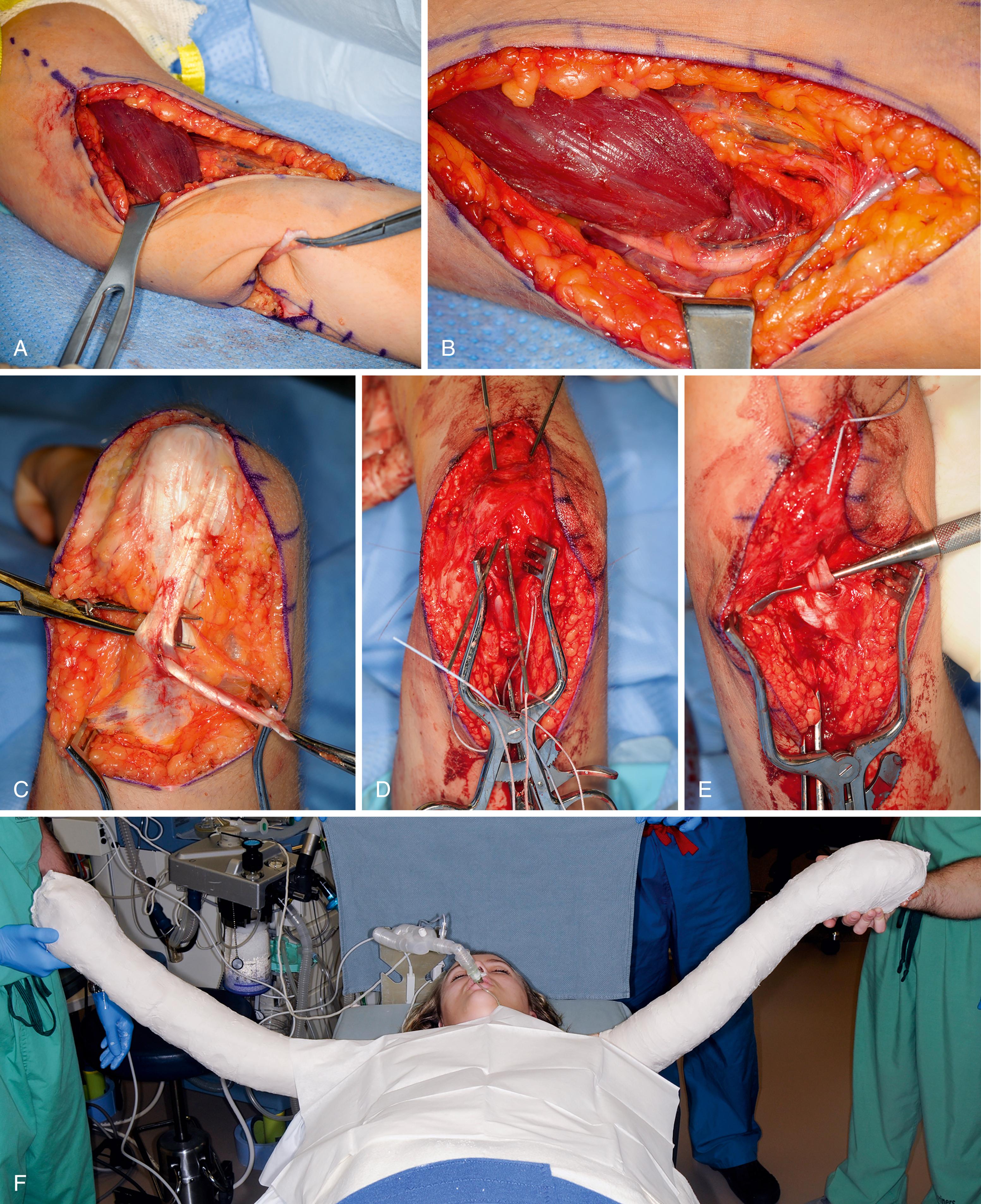 Fig. 33.9, A 16-year-old female 2 years following cervical spinal cord injury. She is ICSHT grade 2 on both arms and is undergoing bilateral biceps to triceps tendon transfer. A, Biceps passed along the medial side of the arm to the posterior incision beneath the ulnar nerve. B, Biceps passed beneath the ulnar nerve. C, Biceps tendon passed though triceps tendon prior to docking into olecranon. D, Suture retrievers to facilitate docking biceps tendon into osseous tunnel. E, Biceps tendon docked into olecranon. F, Postoperative immobilization.