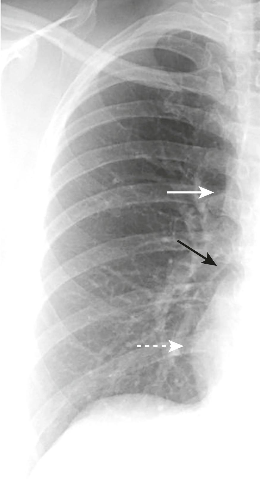 eFig. B.2, Cardiac Contours, Right Side of Heart.