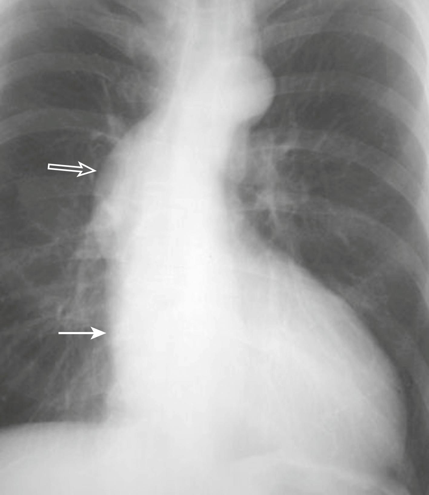 eFig. B.3, Enlarged Ascending Aorta in Aortic Stenosis.