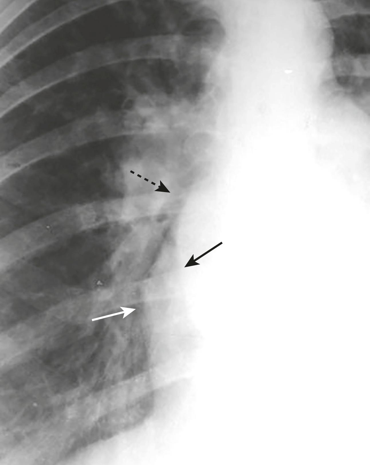 eFig. B.4, ”Double Density” of Left Atrial Enlargement.