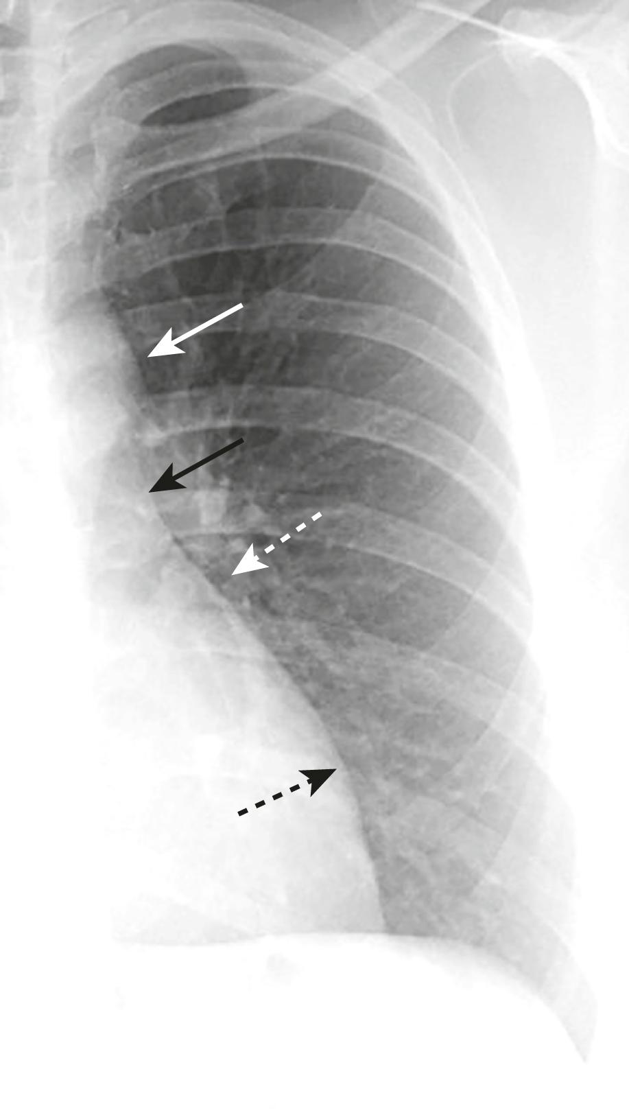 eFig. B.5, Cardiac Contours, Left Side of Heart.