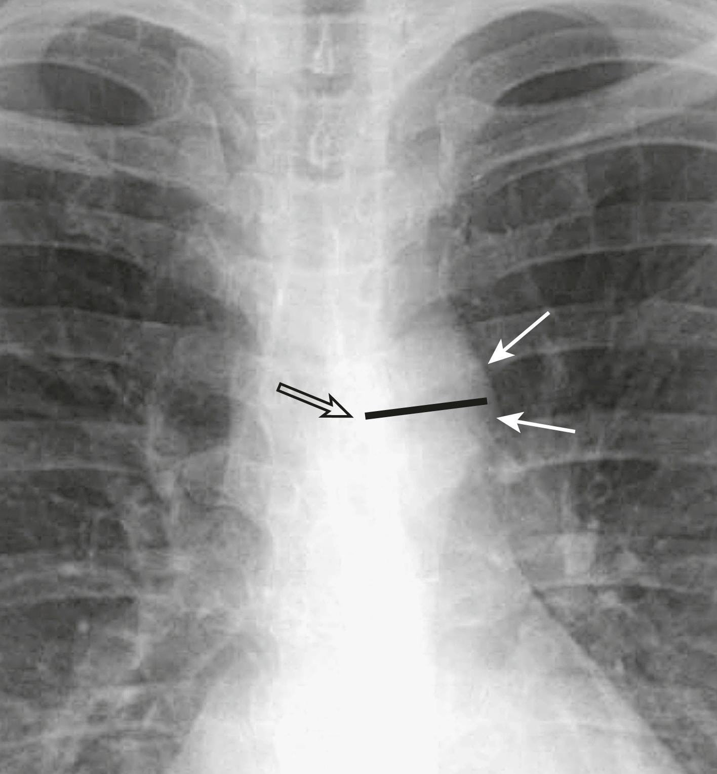 eFig. B.6, Measuring the Size of the Aortic Knob.