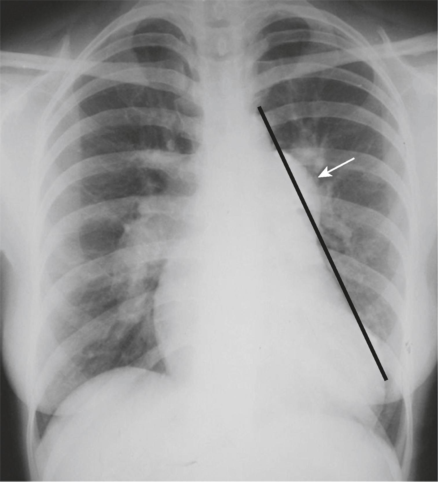 eFig. B.9, Main Pulmonary Artery Projects Beyond the Tangent Line.