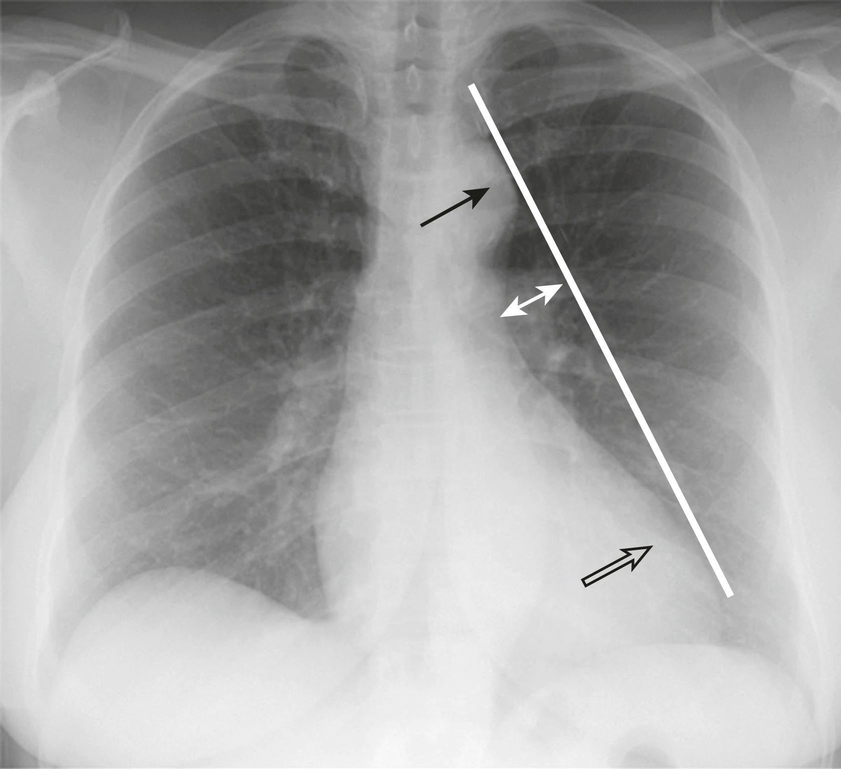 eFig. B.10, “Concave” Main Pulmonary Artery Segment.