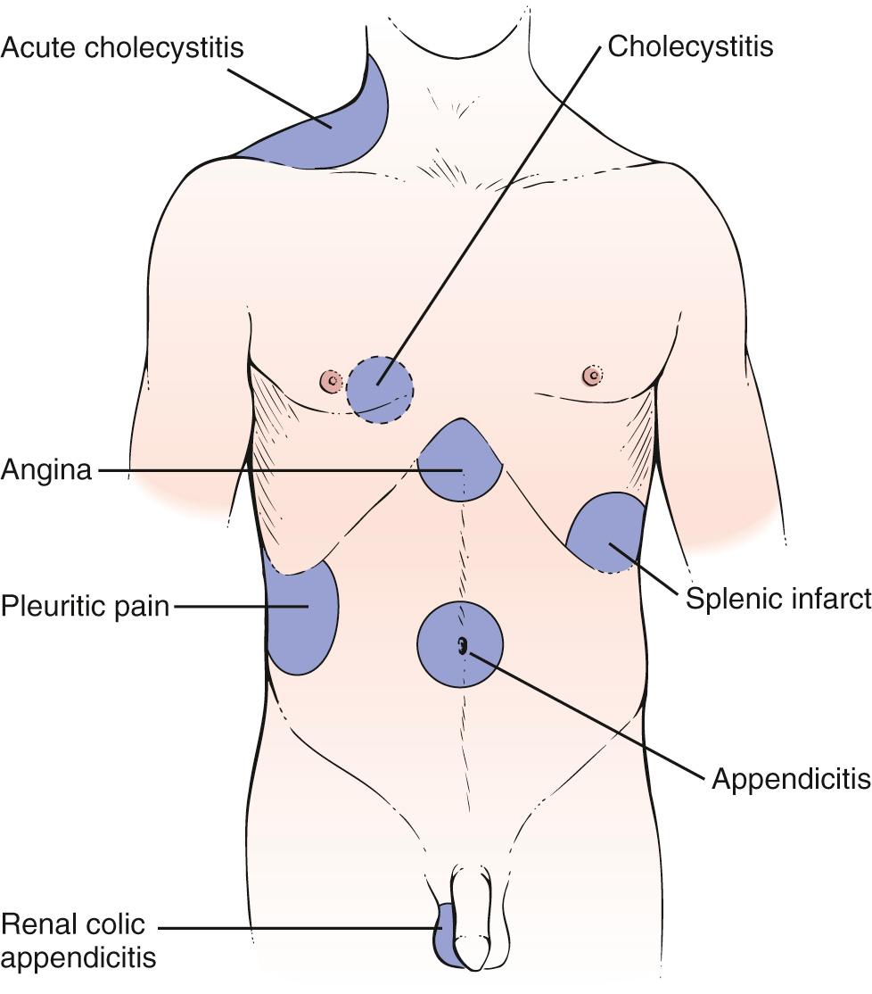 Fig. 17.3, Common Areas of Referred Pain.