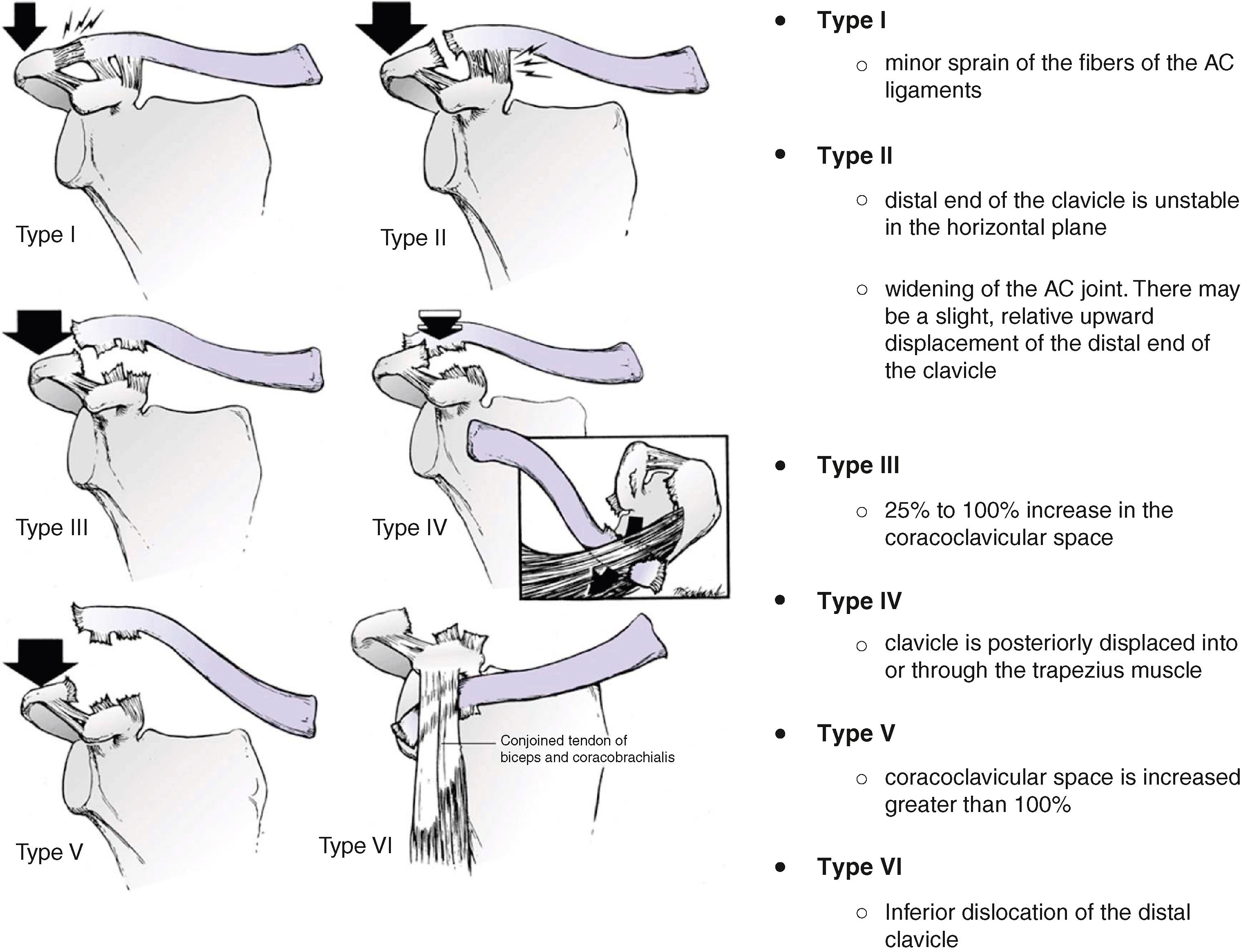 Fig. 12.3, Rockwood’s classification system of acromioclavicular (AC) joint injuries.