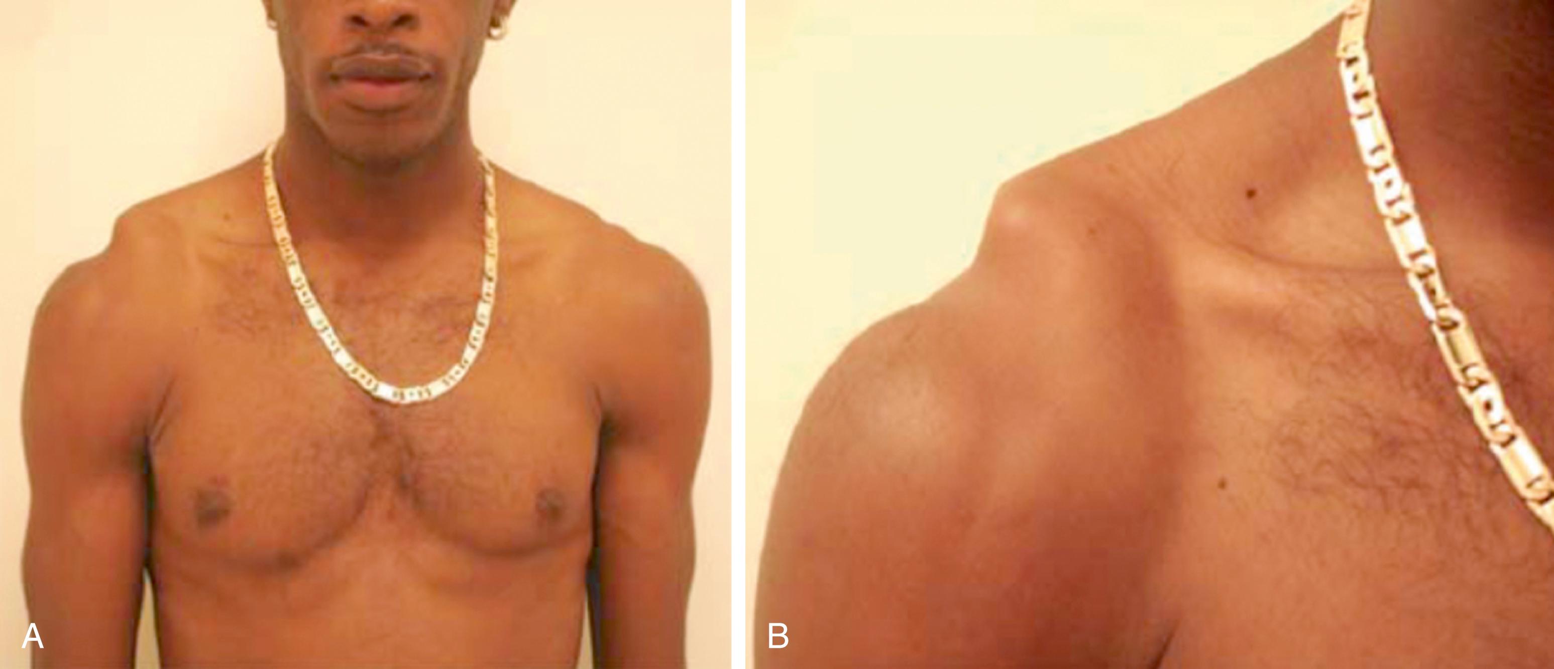 Fig. 12.4, Clinical photographs of a patient presenting with a Rockwood Type V acromioclavicular joint injury.