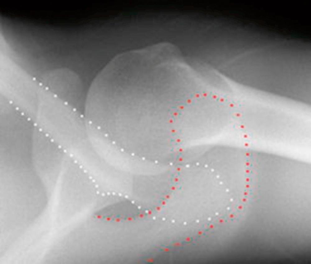 Fig. 12.5, Axillary radiograph of a left shoulder in a patient presenting with a Rockwood Type IV acromioclavicular joint injury. The lateral aspect of the clavicle (white) is displaced posteriorly in relation to the acromial facet of the acromioclavicular joint.