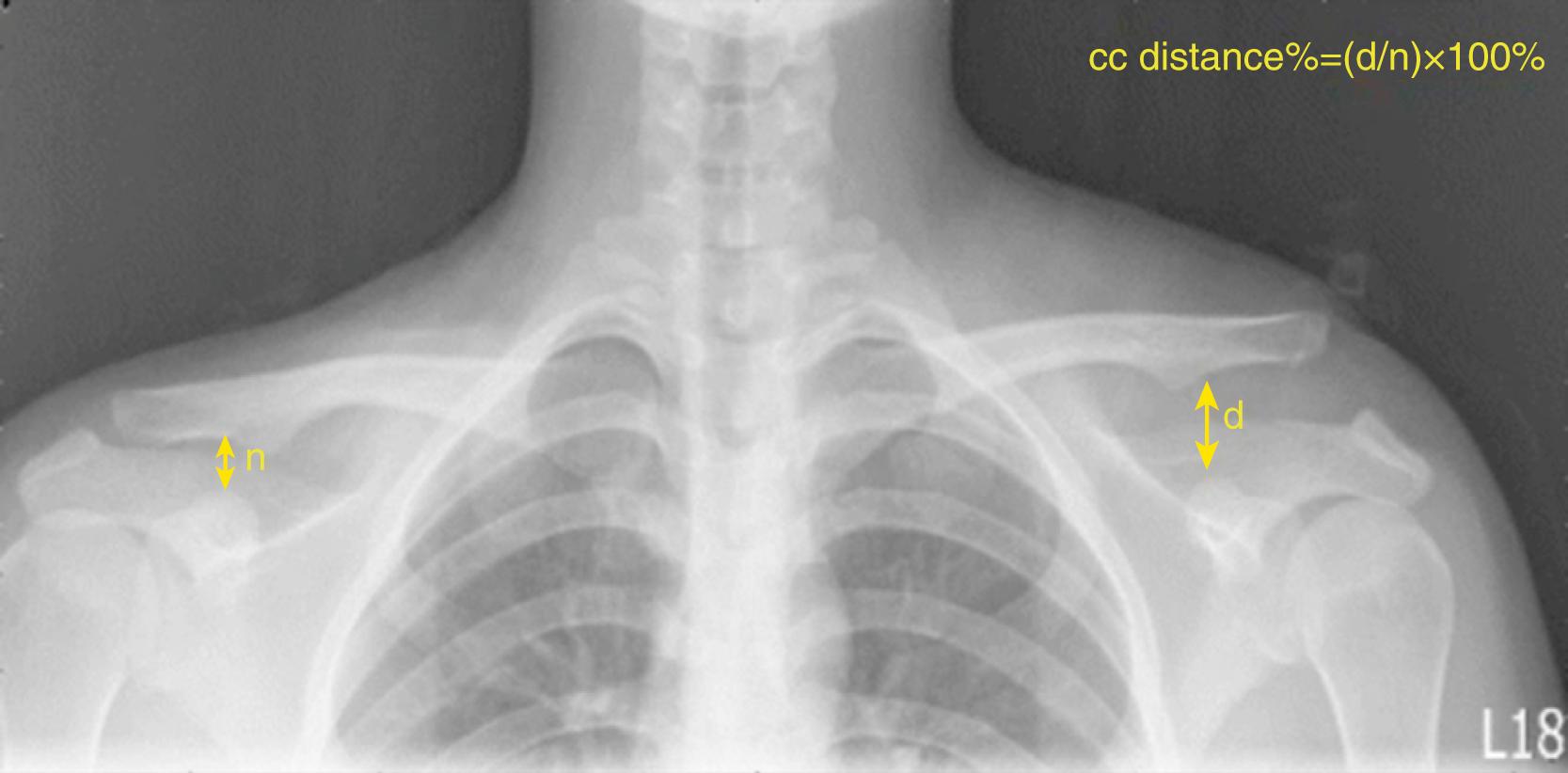 Fig. 12.6, Measurement of coracoclavicular ( CC ) distance on a bilateral Zanca view in a patient presenting with a Rockwood Type V injury.