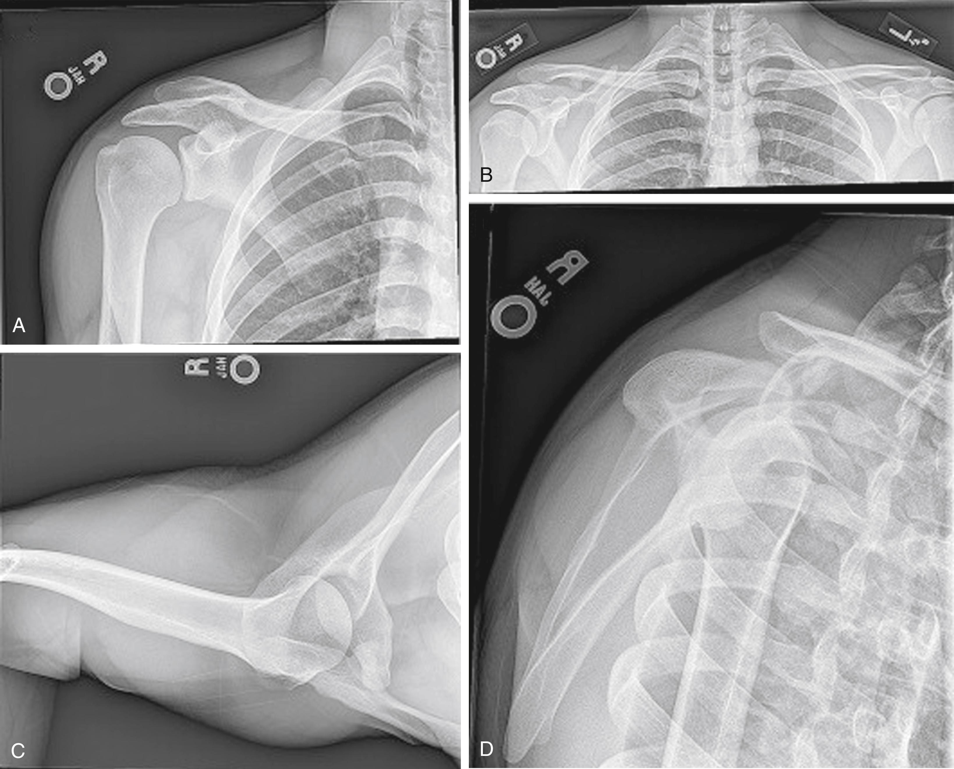 Fig. 12.8, The four projections recommended by the International Society of Arthroscopy, Knee Surgery and Orthopaedic Sports Medicine (ISAKOS) Upper Extremity Committee in a patient presenting with a chronic modified Rockwood Type IIIB injury: (A) true anteroposterior, (B) Zanca, (C) axillary, and (D) cross-body adduction (Basamania) views.