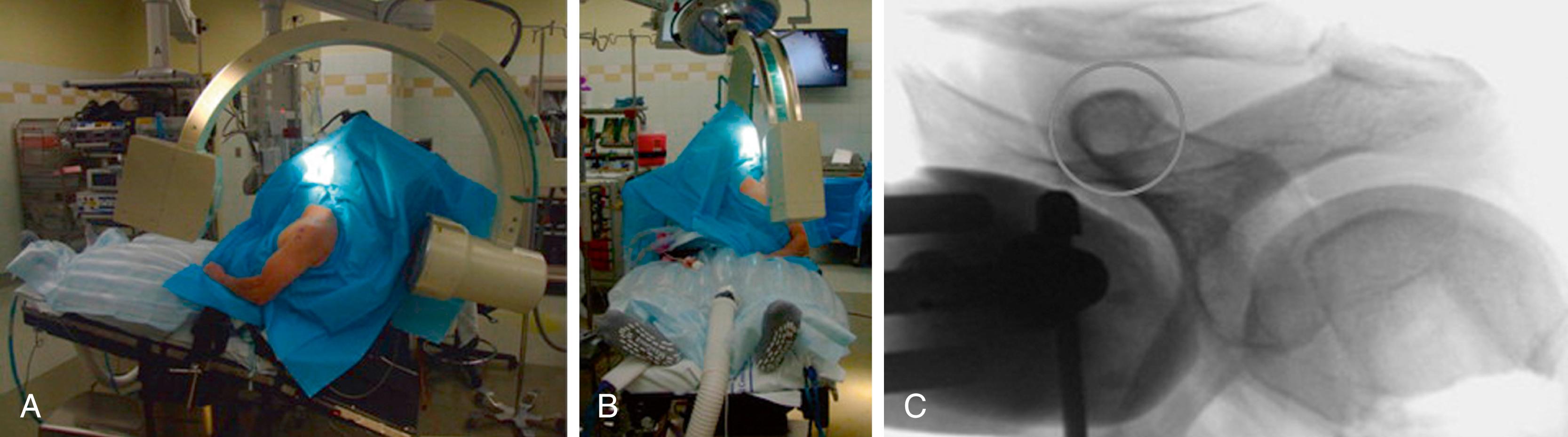 Fig. 12.9, Cortical ring sign: The C-arm is arched over the shoulder and centered on the coracoid in a slight anterolateral to posteromedial direction (A and B) until the coracoid base is fluoroscopically visualized as a ring ( circled ) (C).