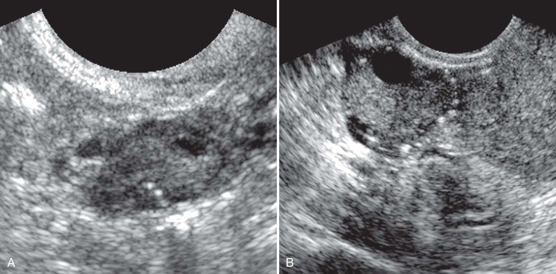 FIG. 16.4, Punctate Echogenic Foci in the Ovary.