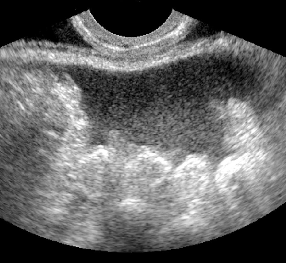 FIG. 16.5, Fluid in Cul-De-Sac.