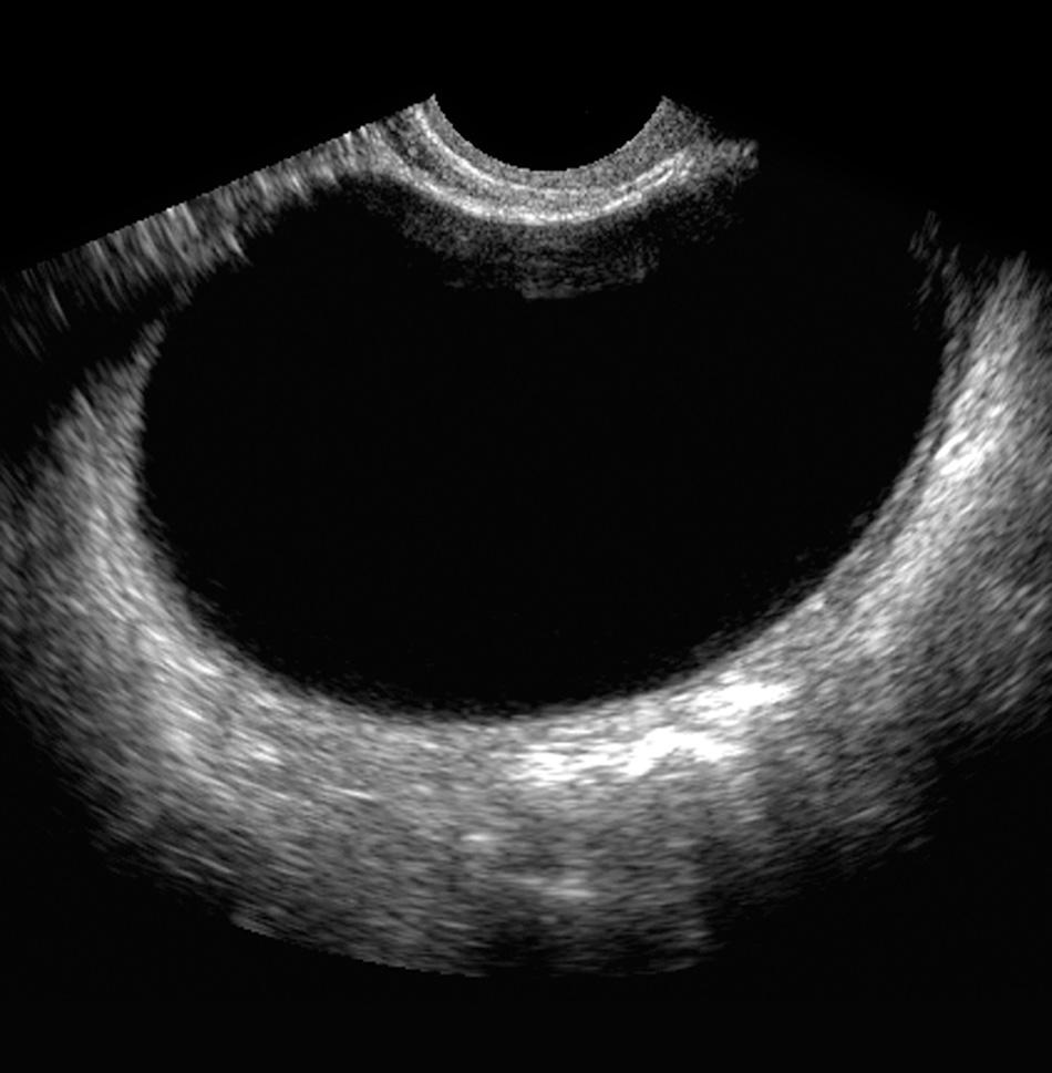 FIG. 16.6, Postmenopausal Large Ovarian Cyst.