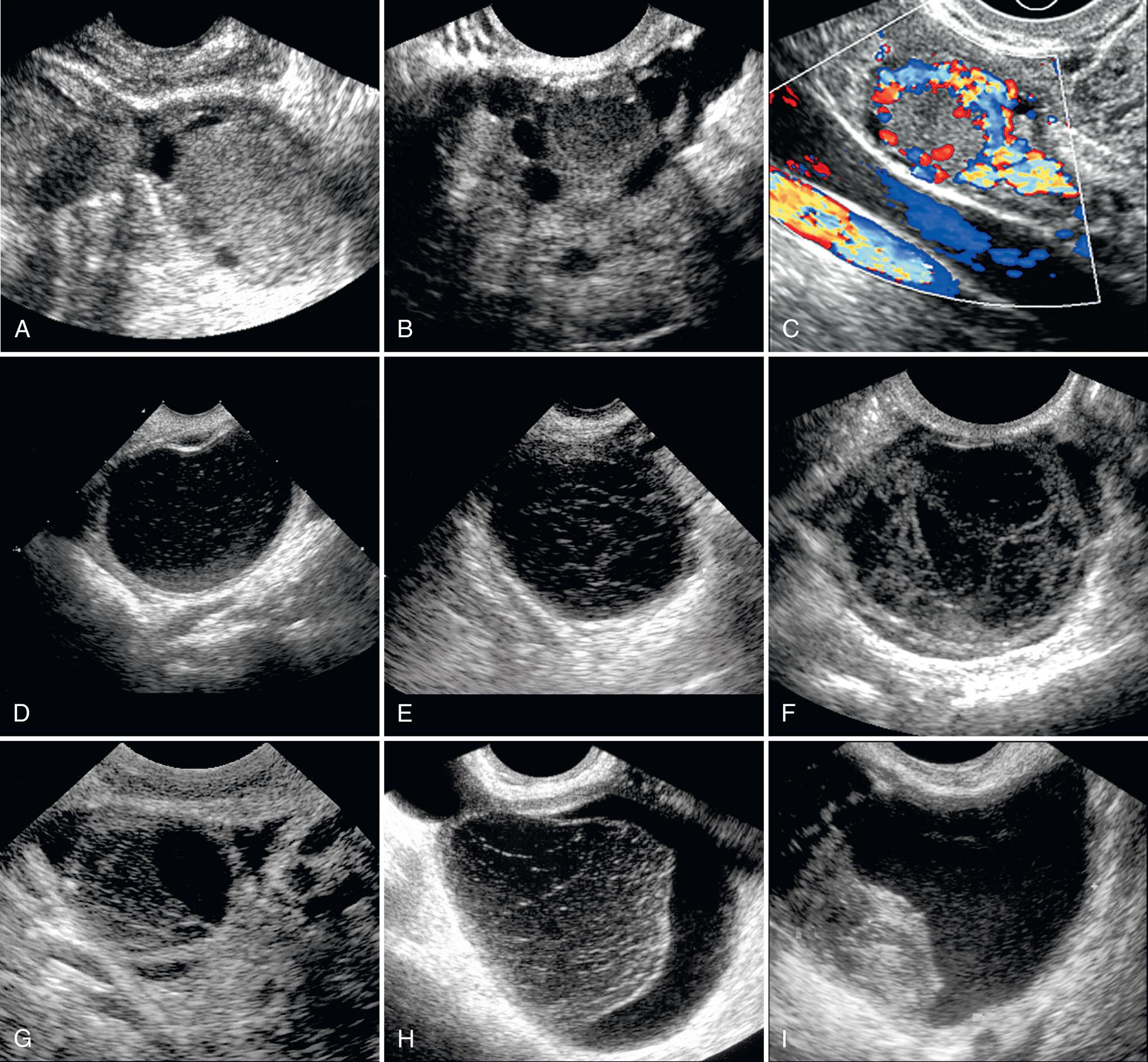 FIG. 16.7, Hemorrhagic Cysts on TVS Scans: Spectrum of Appearances.