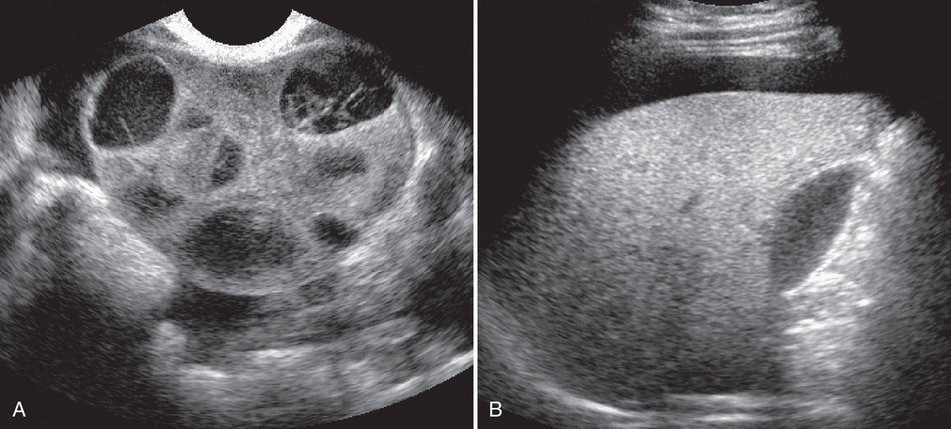 FIG. 16.8, Ovarian Hyperstimulation Syndrome.