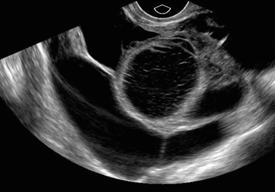 FIG. 16.9, Peritoneal Inclusion Cyst.