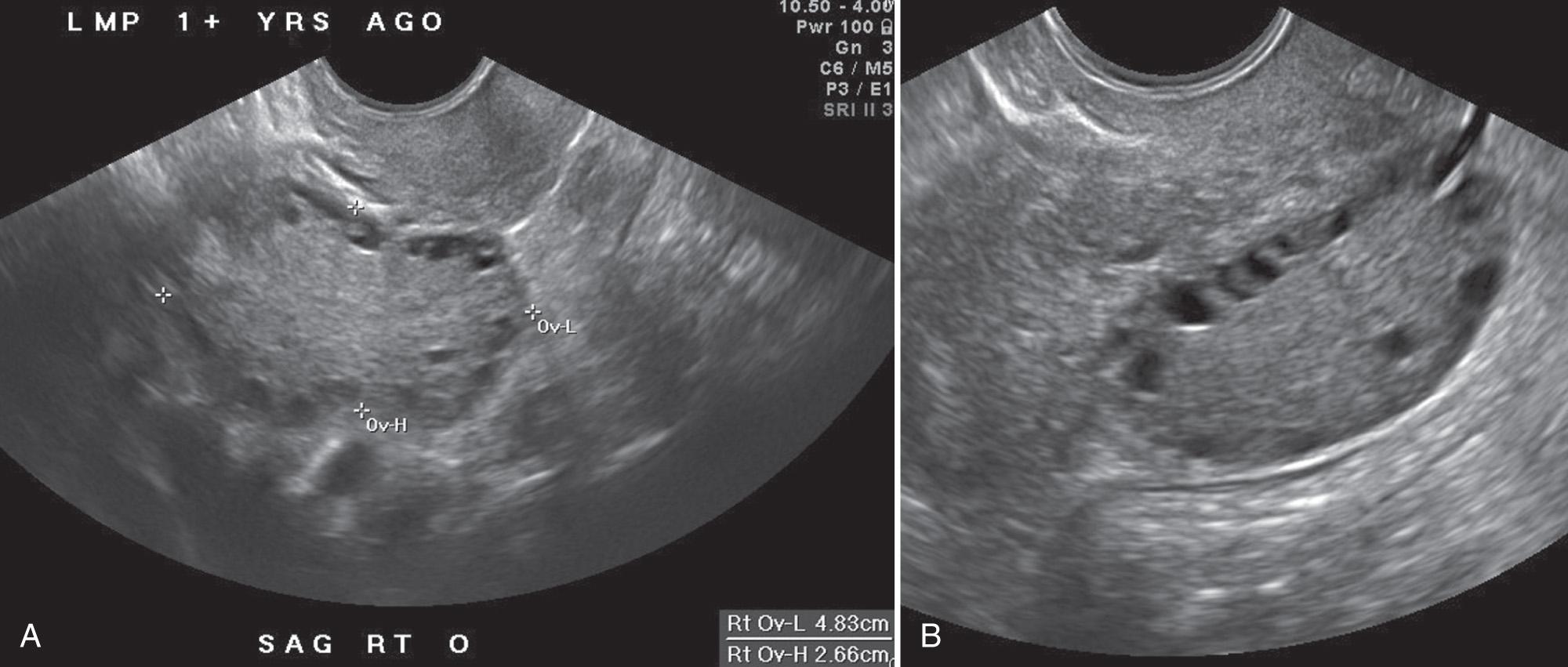 FIG. 16.10, Polycystic Ovaries: Typical Appearance on TVS in Woman With Hirsutism and Oligomenorrhea.