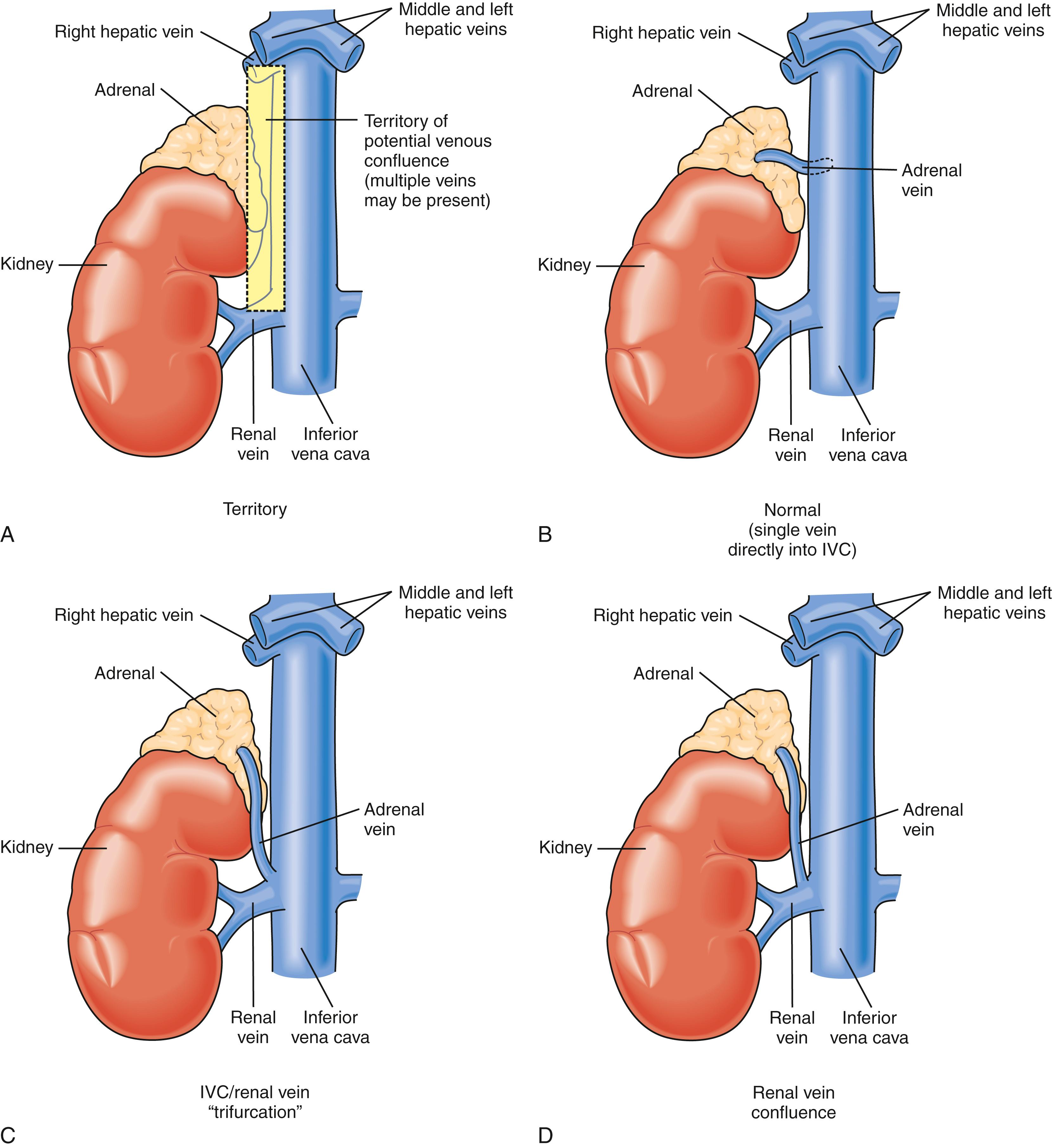 Fig. 40.3, Variations in right adrenal vein anatomy. (A) Territory of potential right adrenal vein confluence. (B) Normal (>80%); single vein directly into the inferior vena cava ( IVC ). (C) IVC–renal vein trifurcation. (D) Renal vein confluence. , cont’d(E) High single vein into the IVC. (F) IVC–right hepatic vein trifurcation. (G) Right hepatic vein confluence.