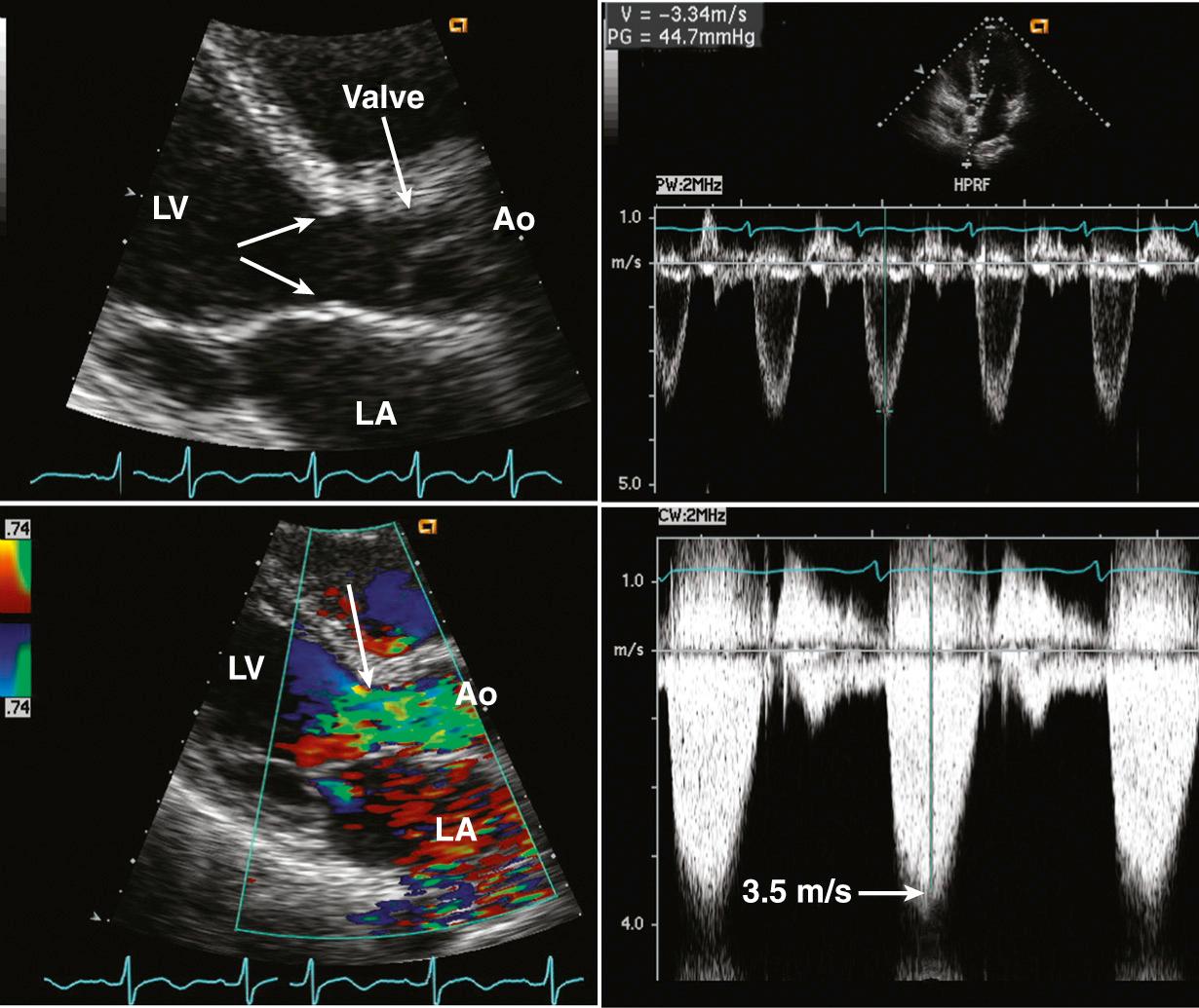 Fig. 17.1, Subaortic stenosis.