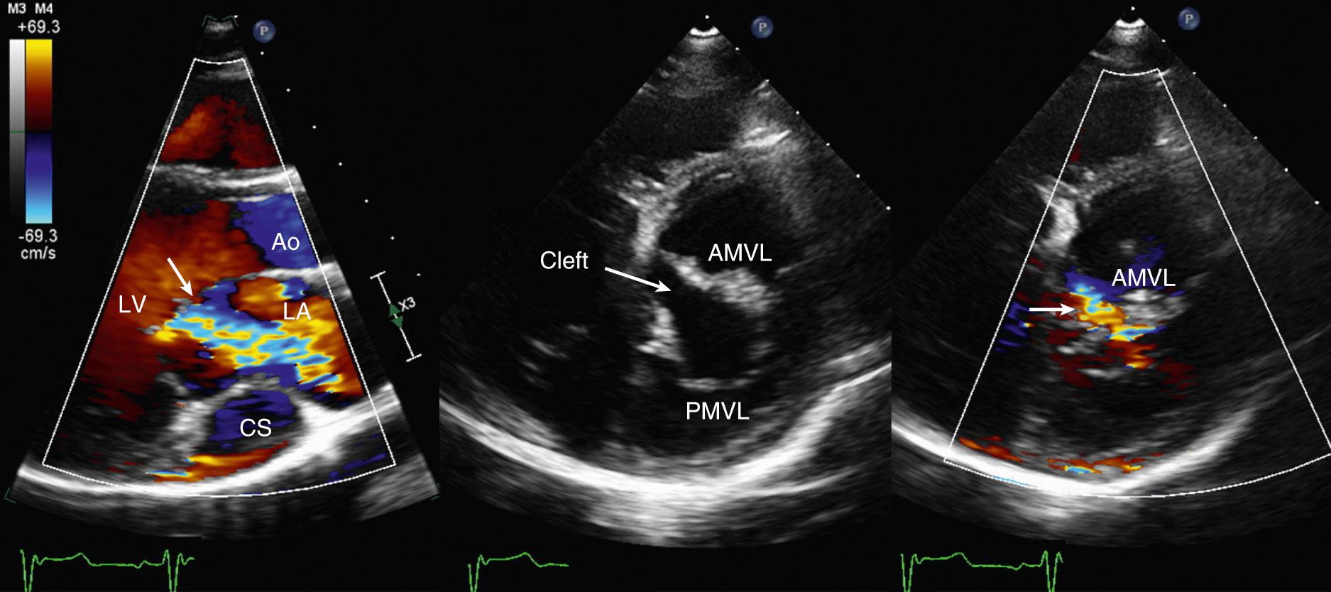 Fig. 17.2, Cleft anterior mitral valve leaflet.