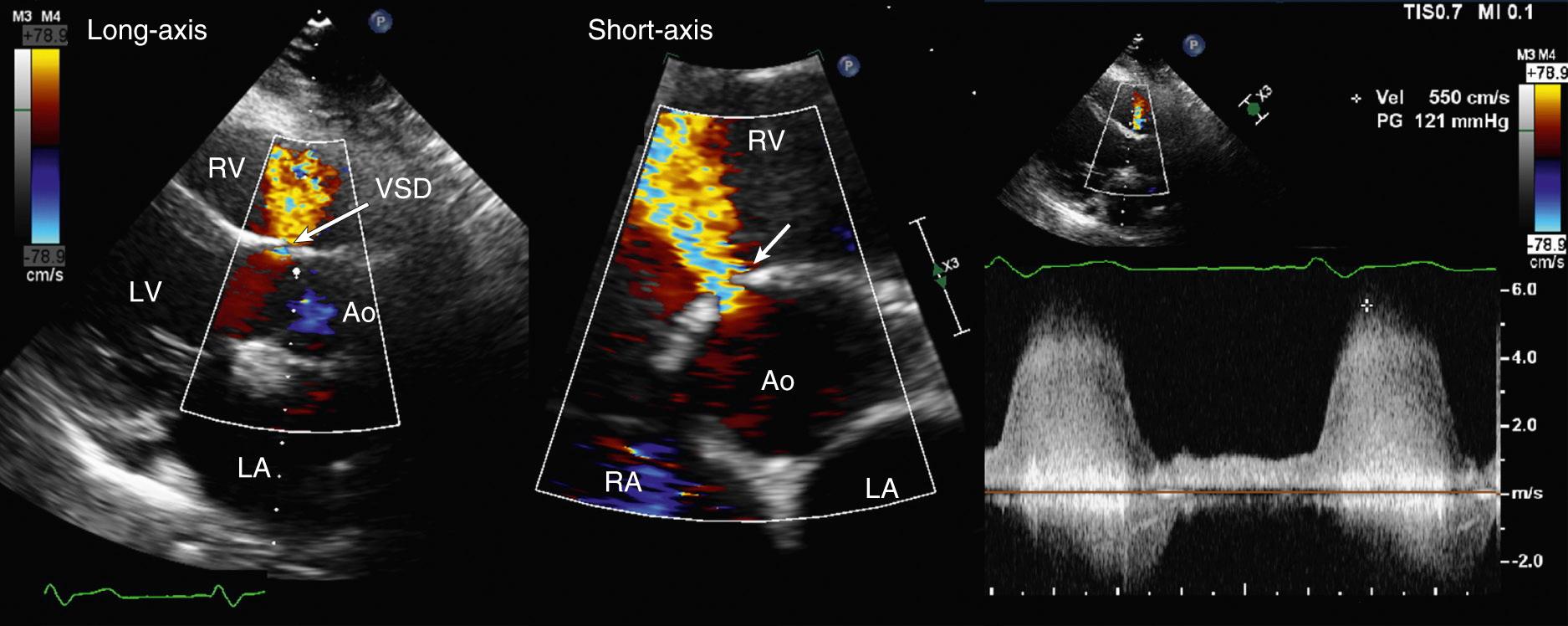 Fig. 17.3, Small, membranous ventricular septal defect.