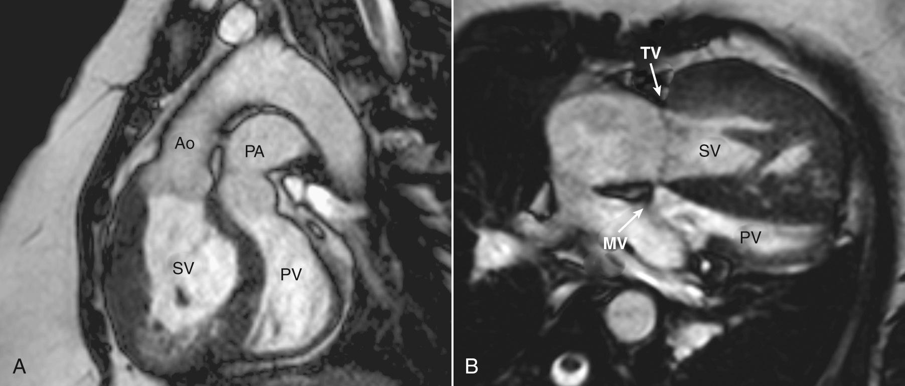 Fig. 17.5, Transposition of the great arteries.