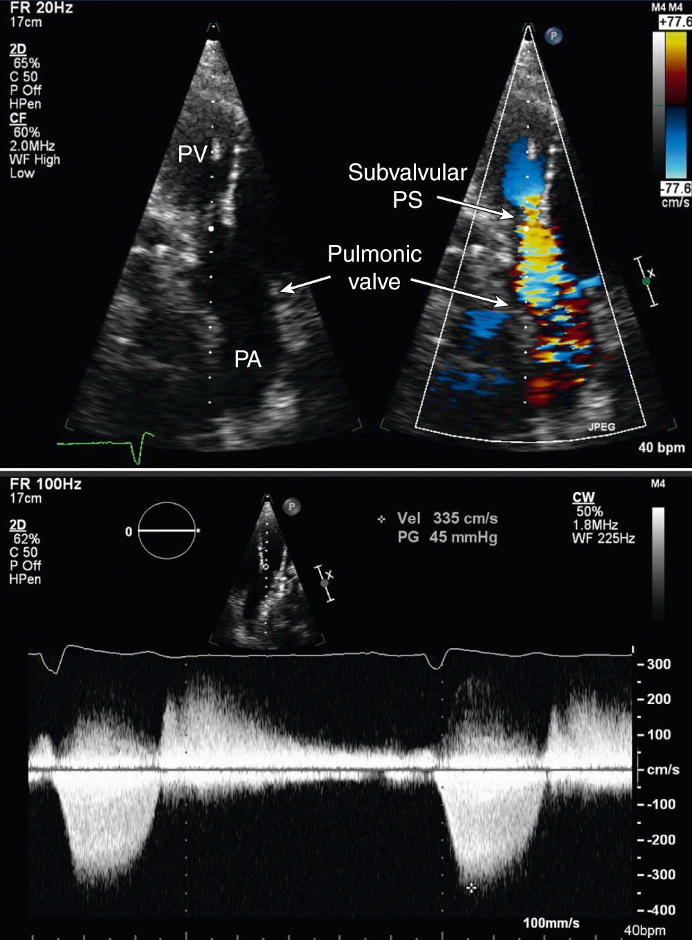 Fig. 17.6, Subpulmonic stenosis.