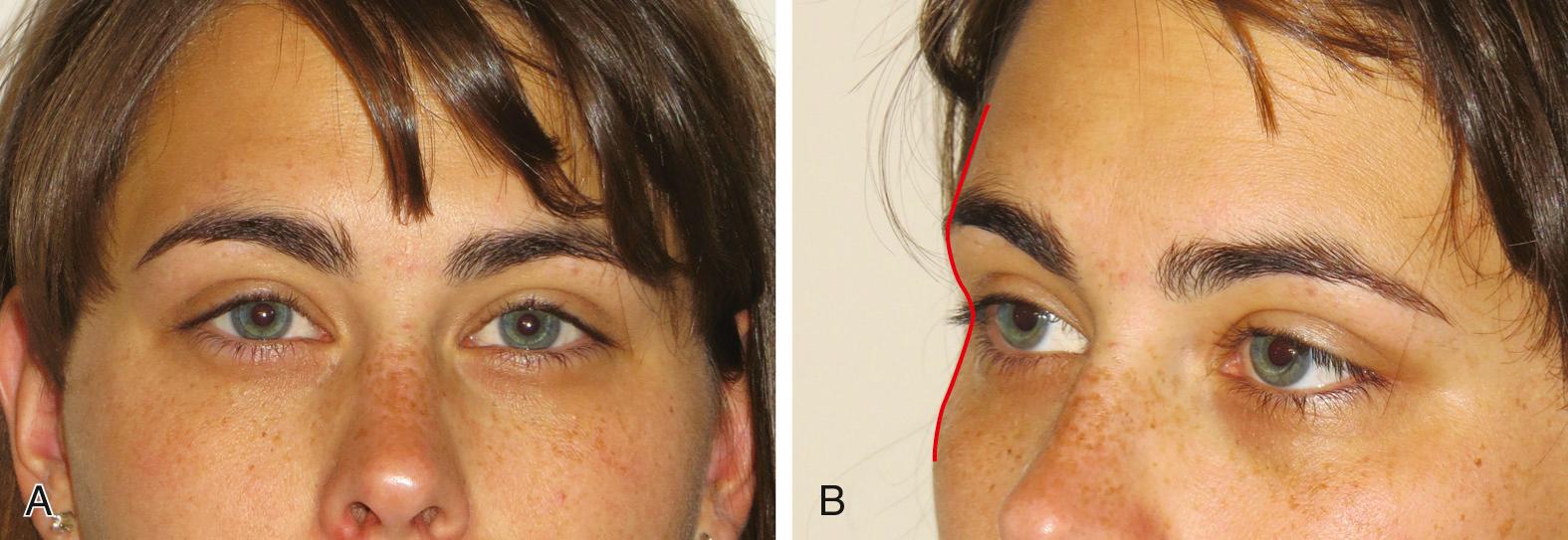 Fig. 25.1, (A) On frontal view, the youthful forehead skin has no creases. The temples are convex, and the superior edge of the zygomatic arch is well disguised. The full width of the eyebrow is visible. (B) On three-quarter view, a full and convex brow gently transitions into the concave orbital rim and then into the full convex cheek. This creates the upper facial “ogee.”