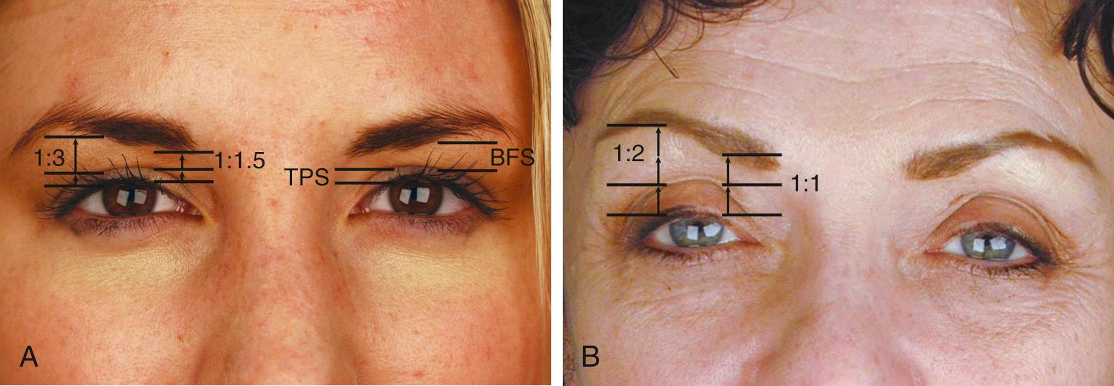 Fig. 25.2, (A) The tarsal plate show (TPS) is the distance from the lash line to the upper lid crease. The brow fat span (BFS) is the distance between the lid crease and inferior edge of the brow. The youthful TPS to BFS ratio is 1 : 1.5 medially and 1 : 3 laterally. (B) With age, bone and soft tissue loss around the eye increases the amount of TPS and decreases the BFS. In some patients, this can give the illusion of brow ptosis, when in fact the actual distance of the brow from the lash line is the same or even increased.