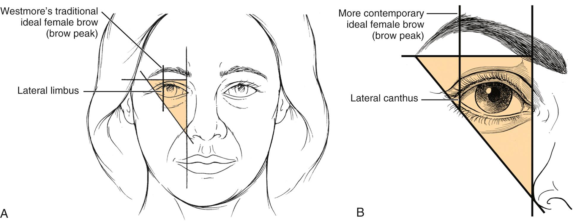 Fig. 25.4, (A) Westmore's traditional ideal female eyebrow with the peak at the lateral limbus. (B) A more contemporary ideal female eyebrow with the peak at the lateral canthus.